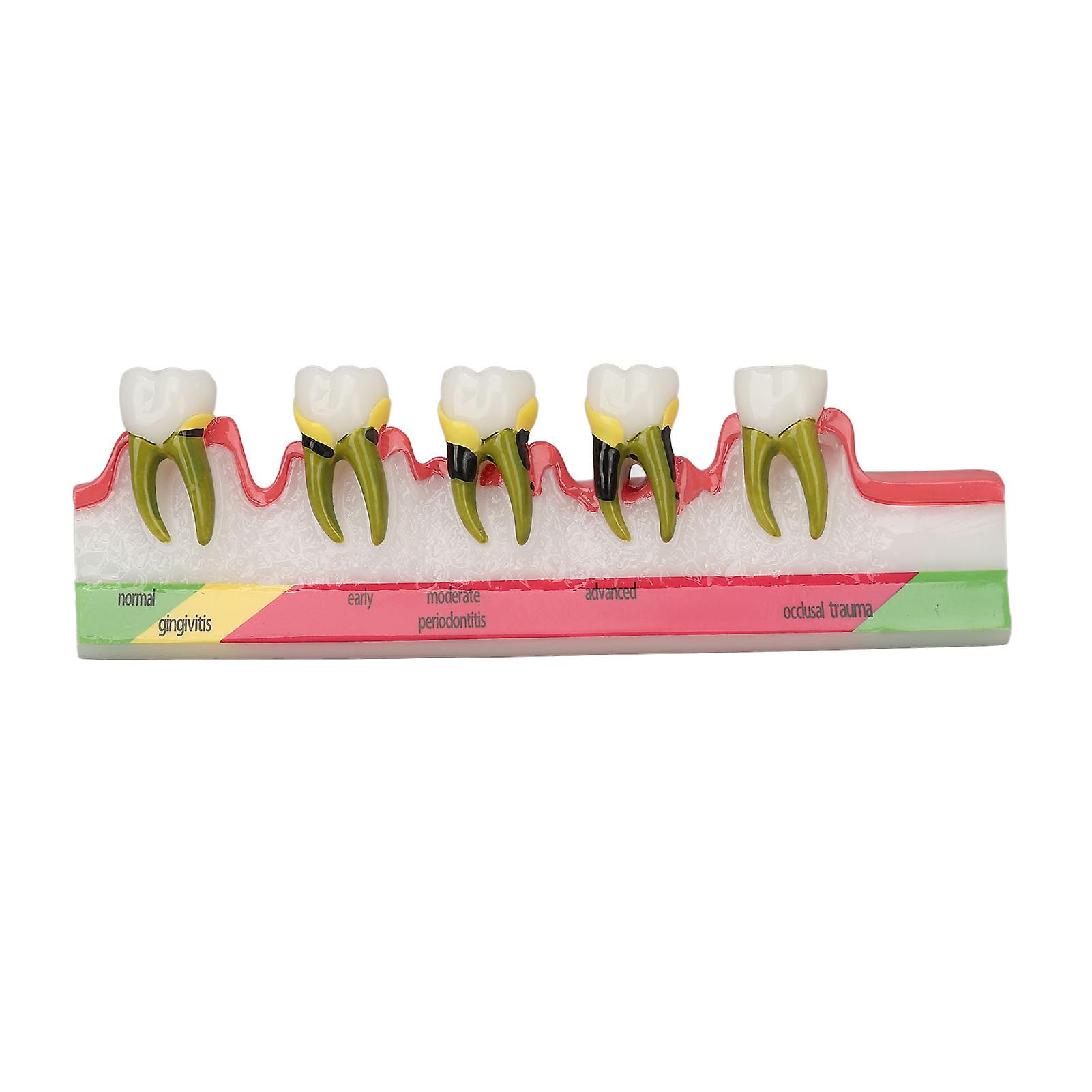 Dental Periodontal Disease Model, Different Stages, Resin Display Model for Dental Periodontitis