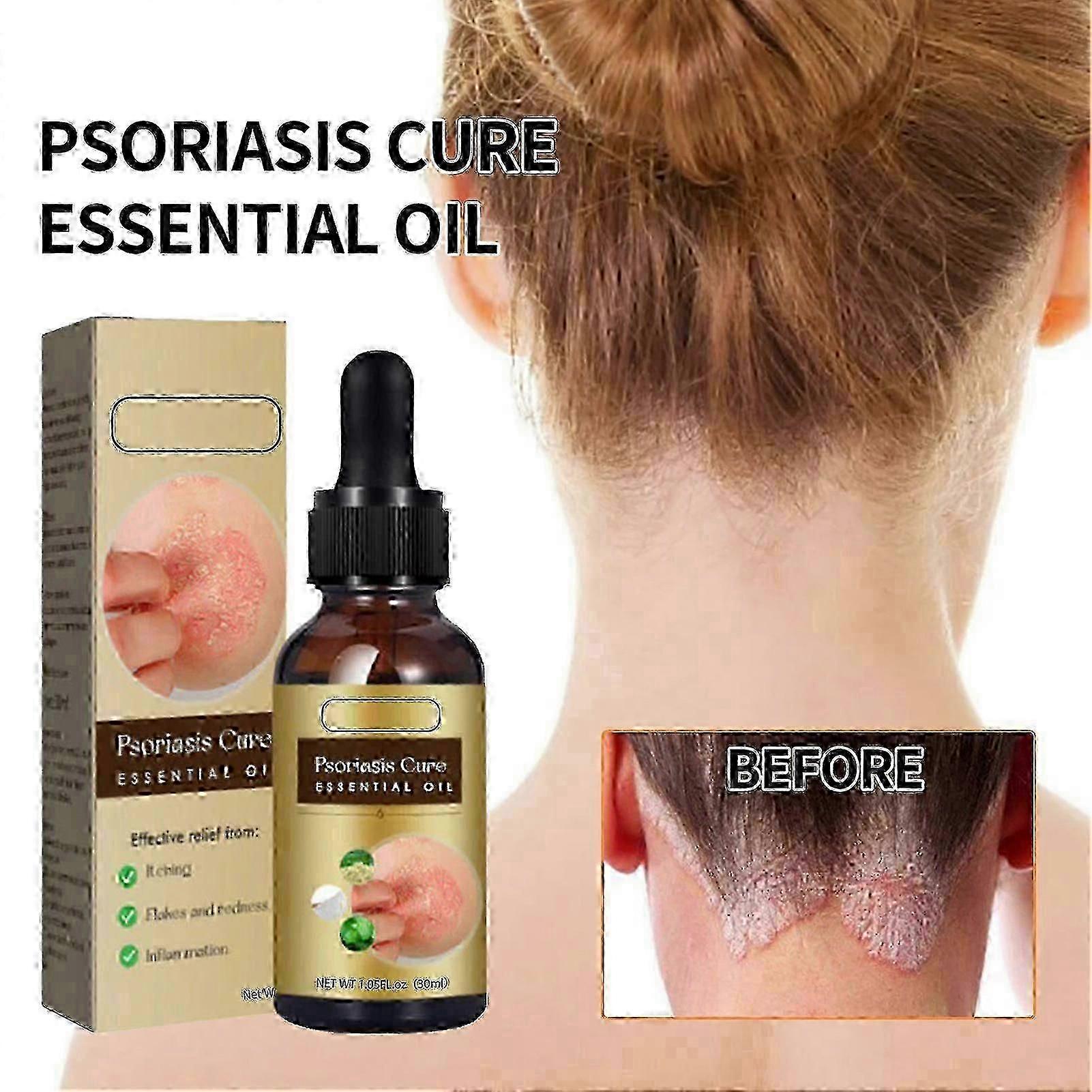 2025 Psoriasis Dandruff Treatment for Scalp, Anti Itching Follicle Booster