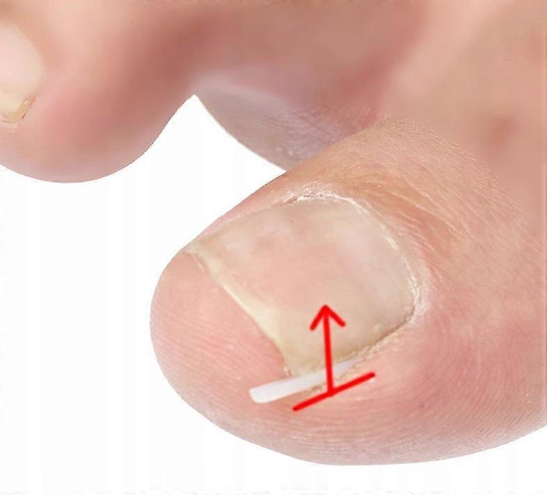 Silicone Tubes For Ingrown Nails 20 Pieces