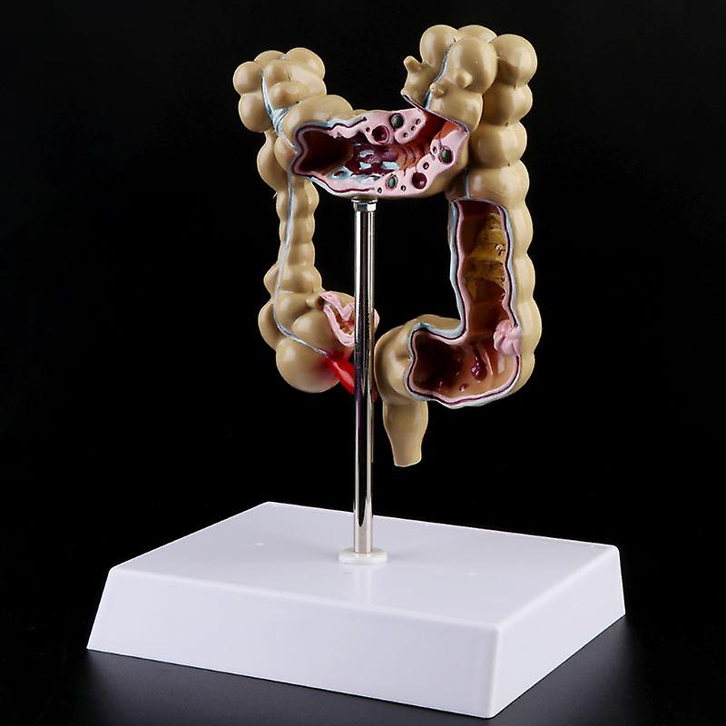 Colorectal lesion model human colon large intestine pathological diseases model medical organizer anatomy 14x17x21cm