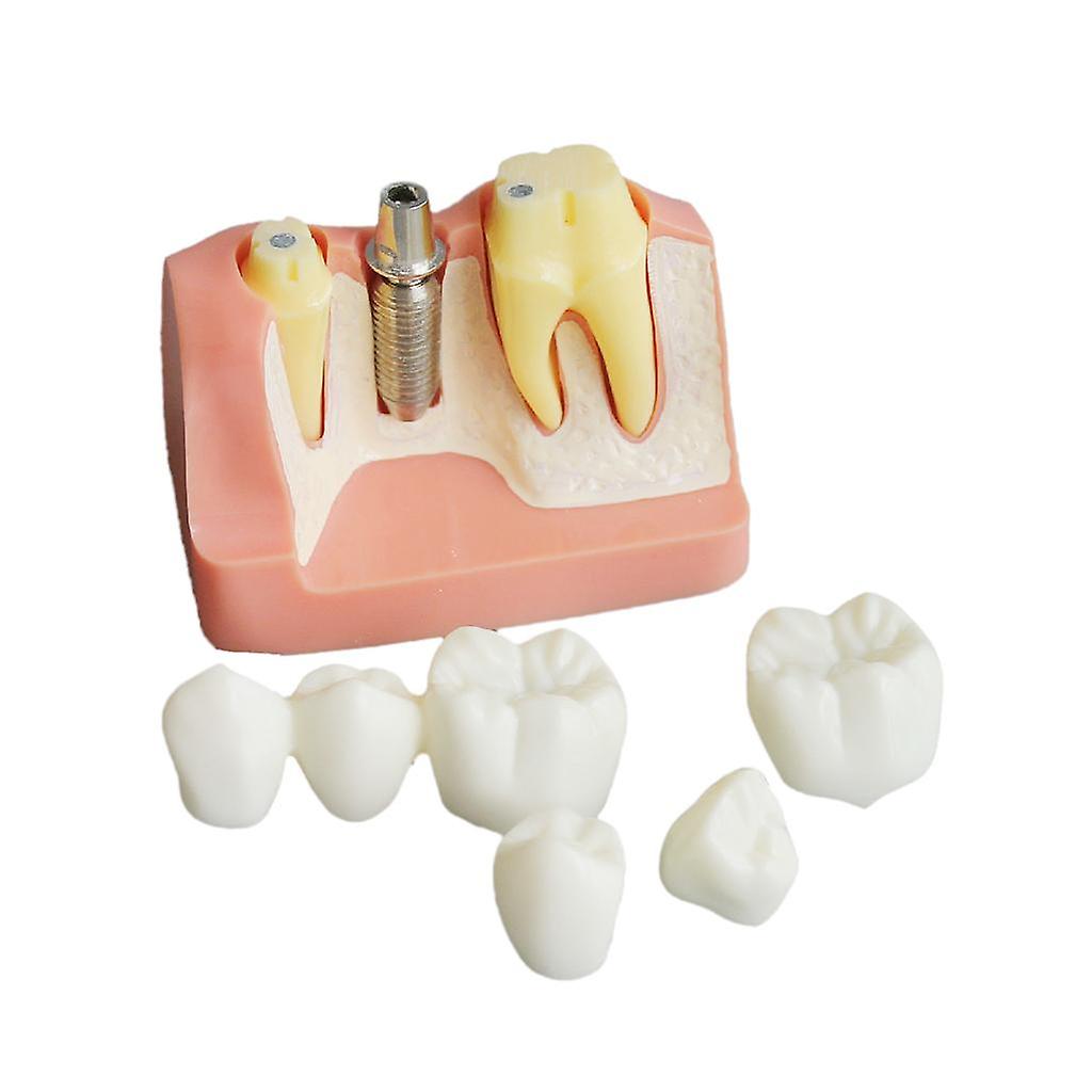 Implant Analysis Bridge Demonstration Teeth Teach Model