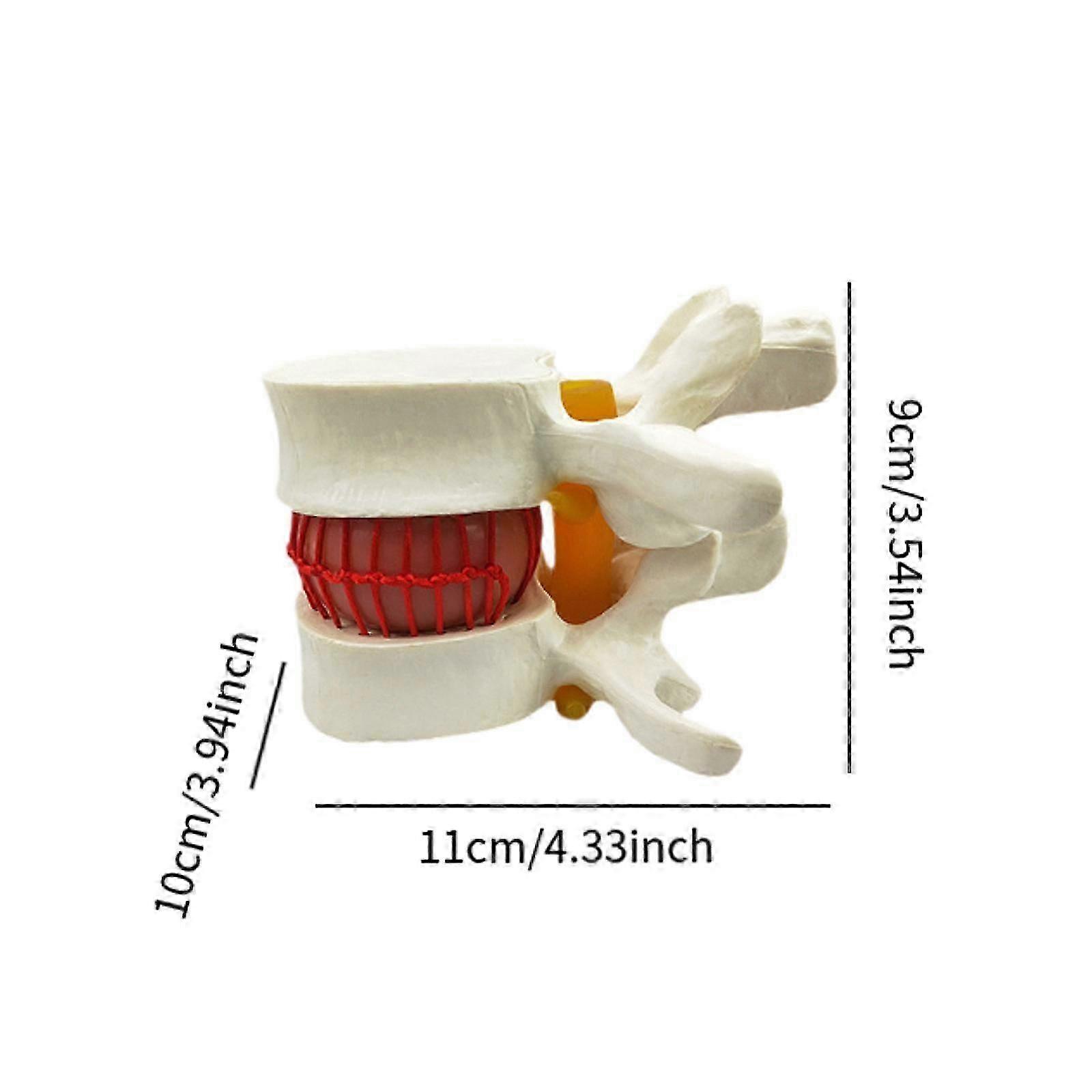 Spinal Model for Educational Use in Laboratories and Classrooms, Ideal for Demonstrating Lumbar Disc Herniation