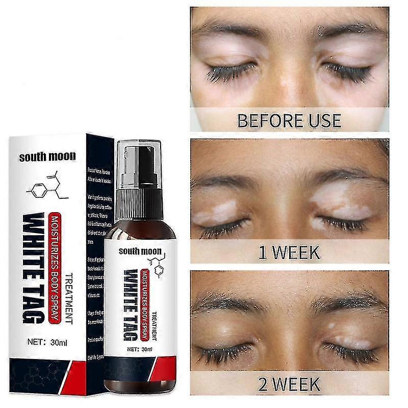 بخاخ البهاق ، علاج البهاق للبهاق الجلدي ، بخاخ العناية بالبهاق لتقليل البقع البيضاء