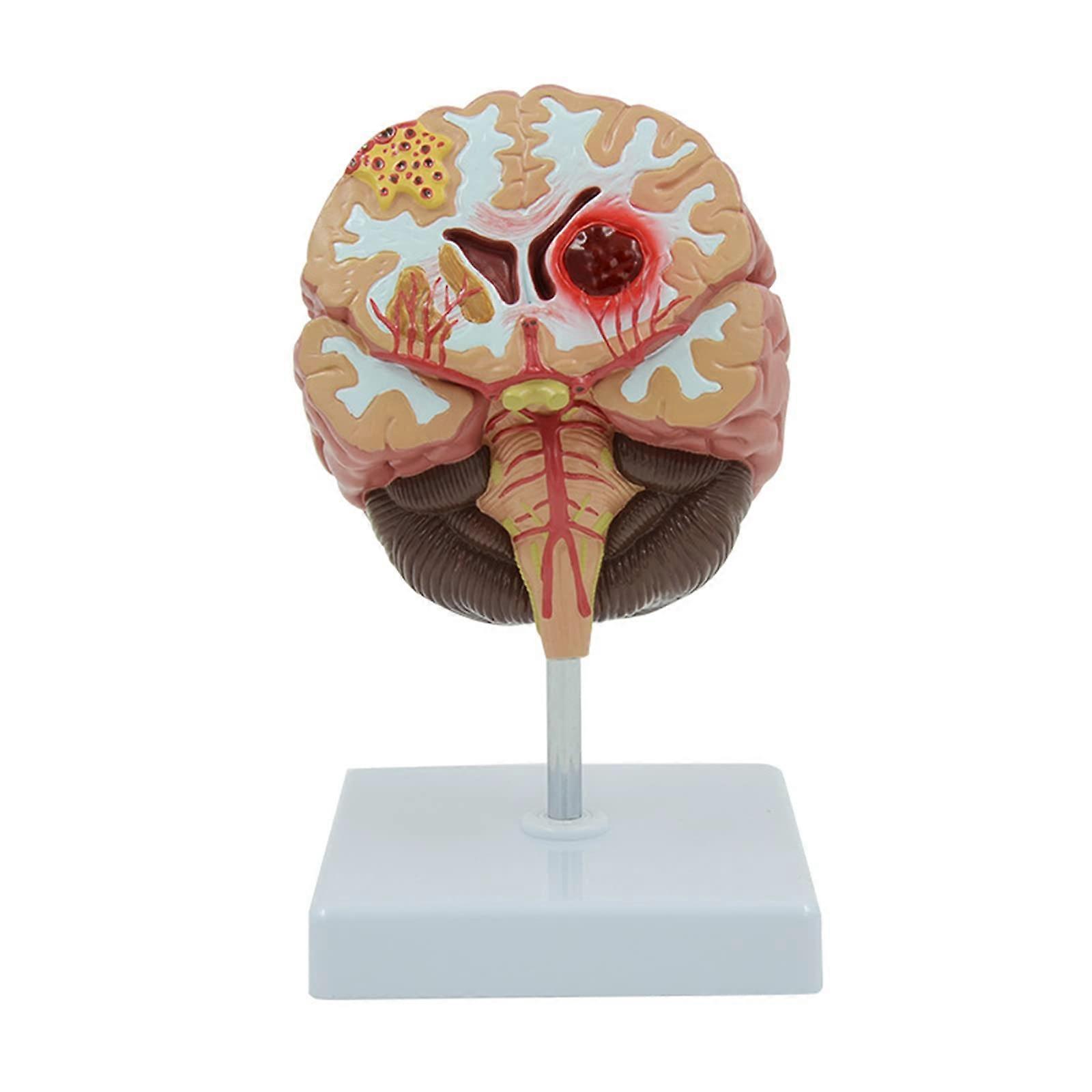 Human Brain Anatomical Model with Cerebral Hemorrhage and Arteriovenous Malformation for Medical Teaching and Classroom Demonstration
