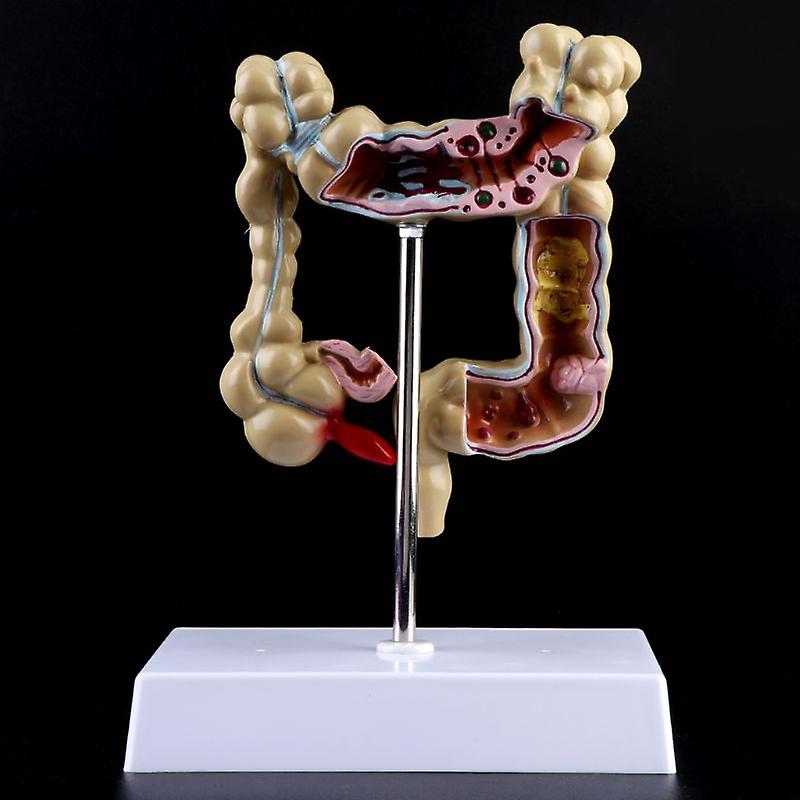 Colorectal Lesion Model Human Colon Snake Large Intestine Pathological Diseases Model Medical Organizer Anatomy