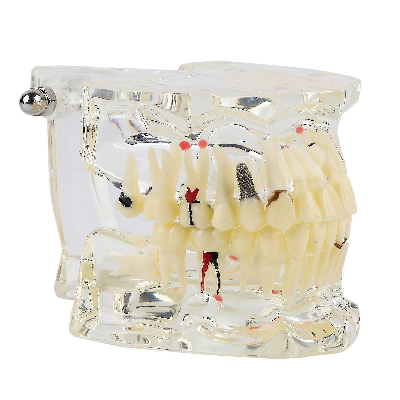 New Dental Teaching Study Standard Tooth Model Demonstration Disease Educational