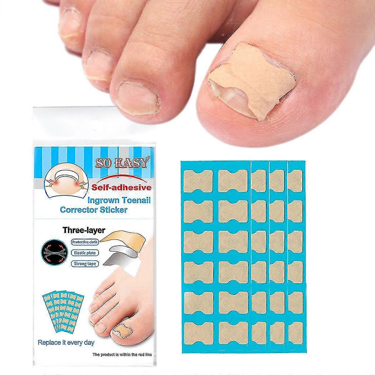 Glue-free Ingrown Nail Paste Ingrown Nail Corrector Tool