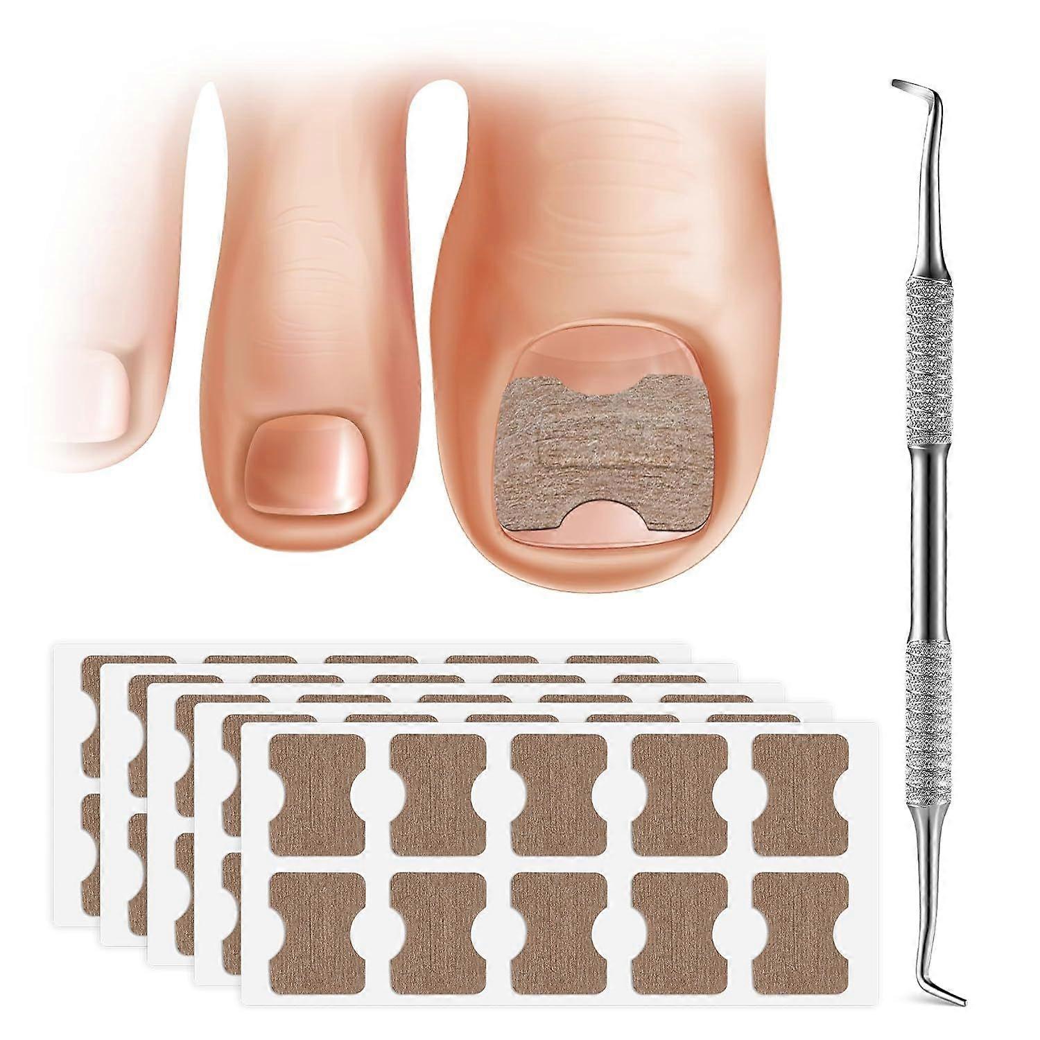 2025 Latest Model 50 PCS Breathable Ingrown Toenail Corrector Patch with