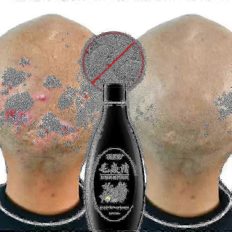 Scalp Hair Follicle Shampoo Antibacterial Anti-itching Mites Oil Control Psoriasis And Scalp Cleansing Shampoo Skincare Product---Code17767