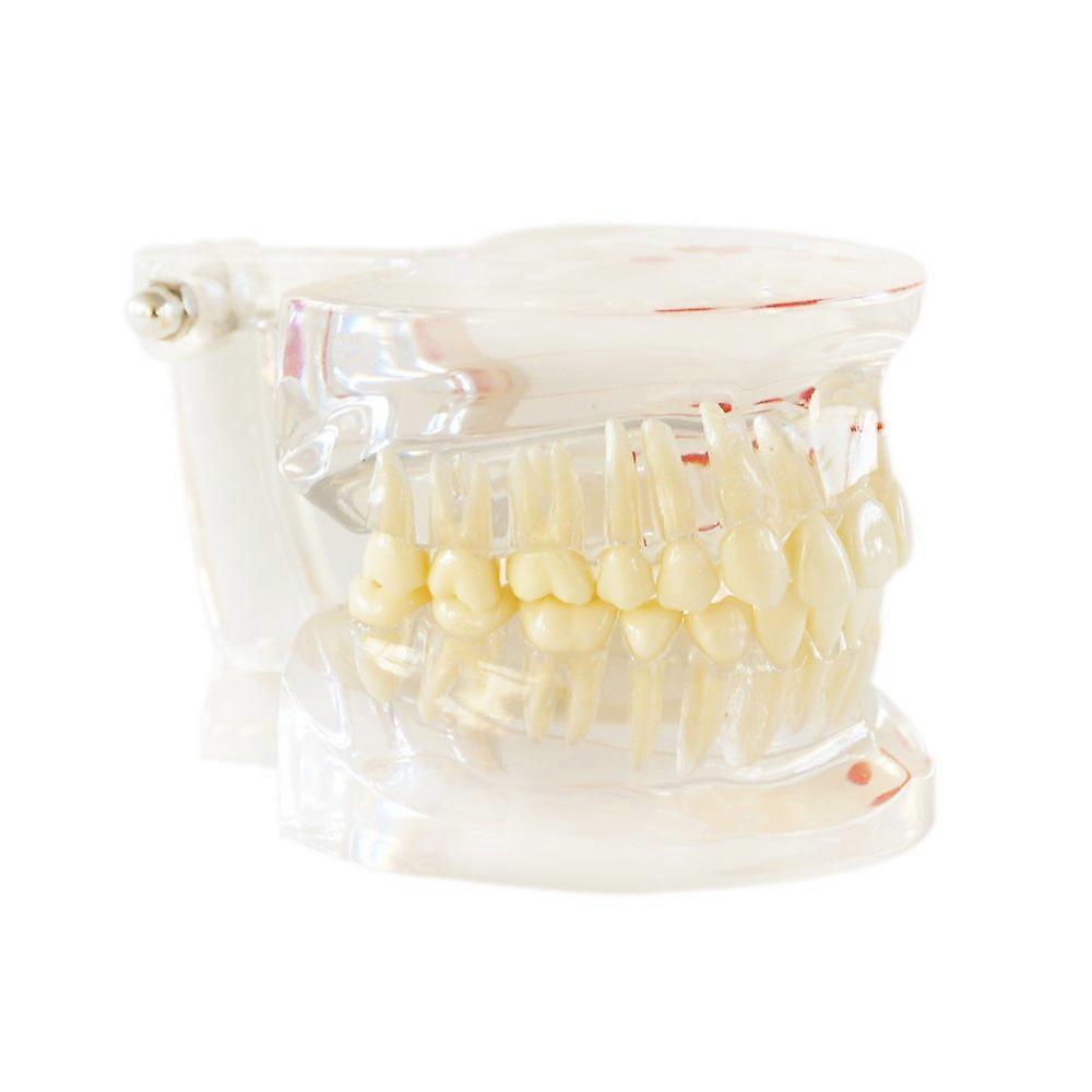 Dental Teeth Model with Clear Pathology Visualization, Removable Halfside Design for Teaching