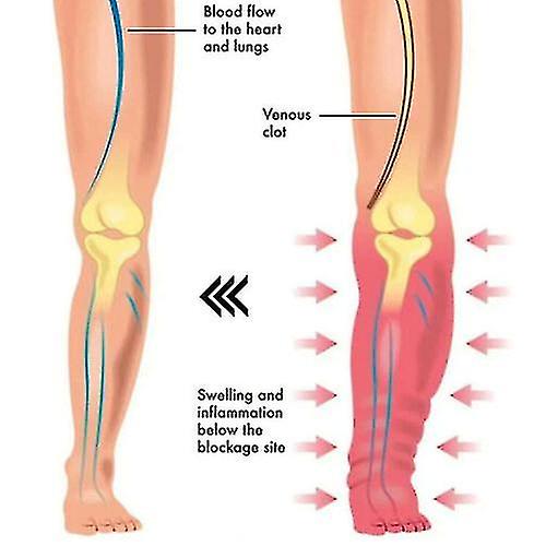 Anillo magnético terapéutico de drenaje linfático