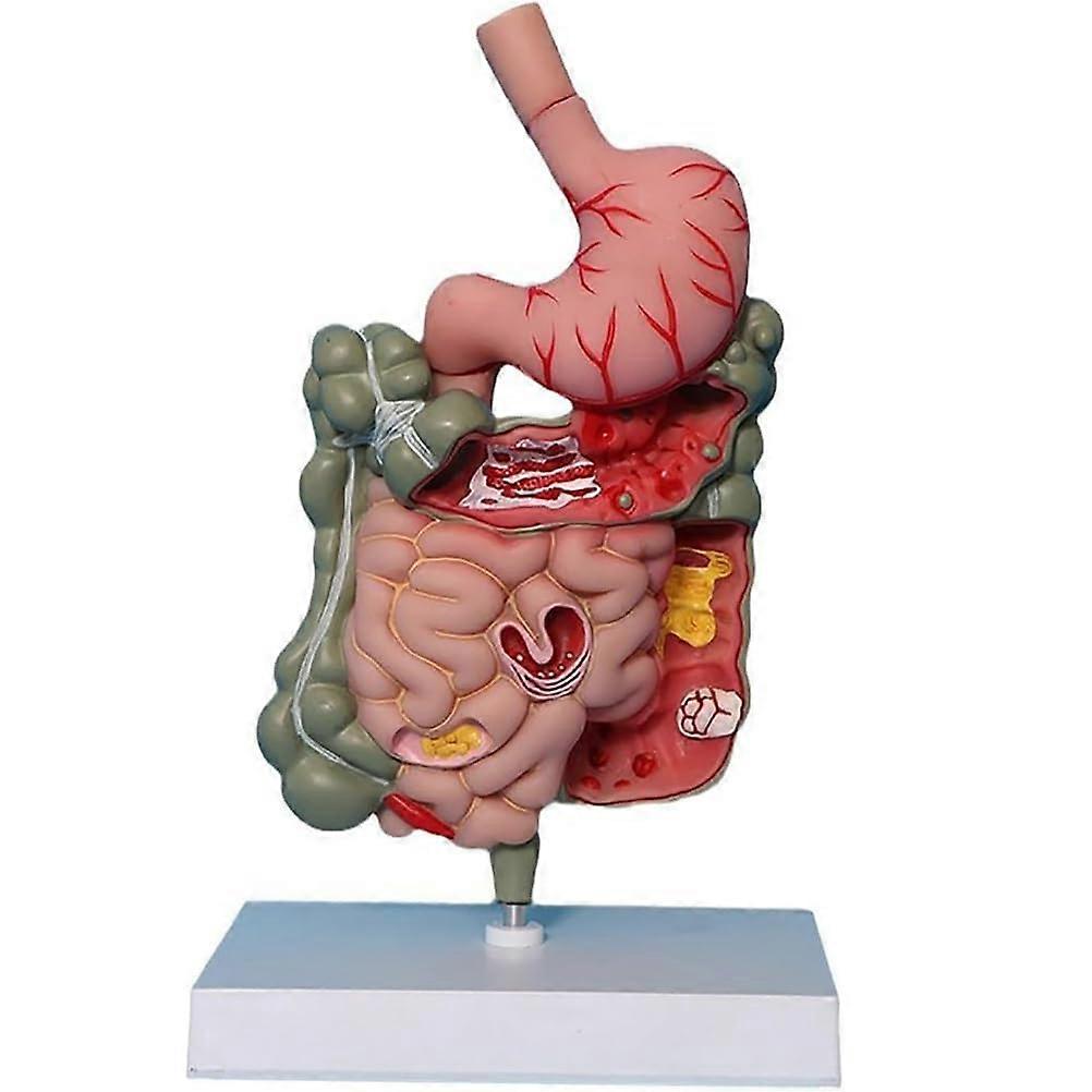 Human Colon Anatomy Model with Clear Lesion Visualization, Removable Digestive System Pathology Model