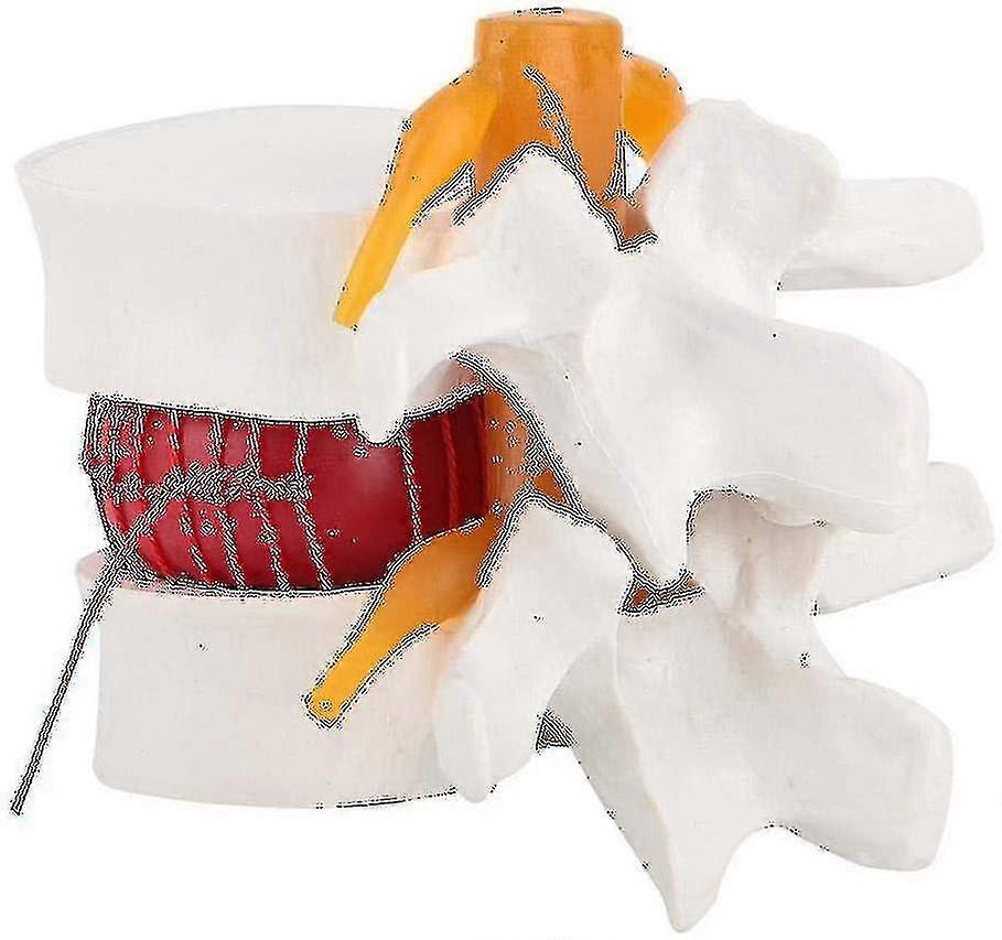 Human Anatomy Lumbar Disc Herniation Model - Medical Demonstration