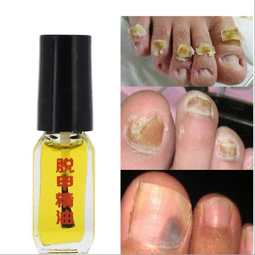 Infection Toe Nail Fungus Oil
