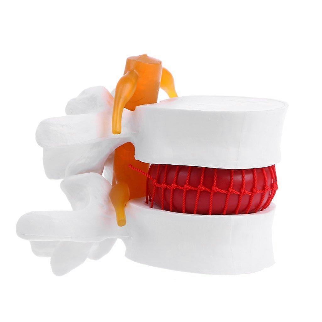 Lumbal Hernia Model - Anatomical Teaching Aid for Human Anatomy Learning, Life-Size, Durable Material