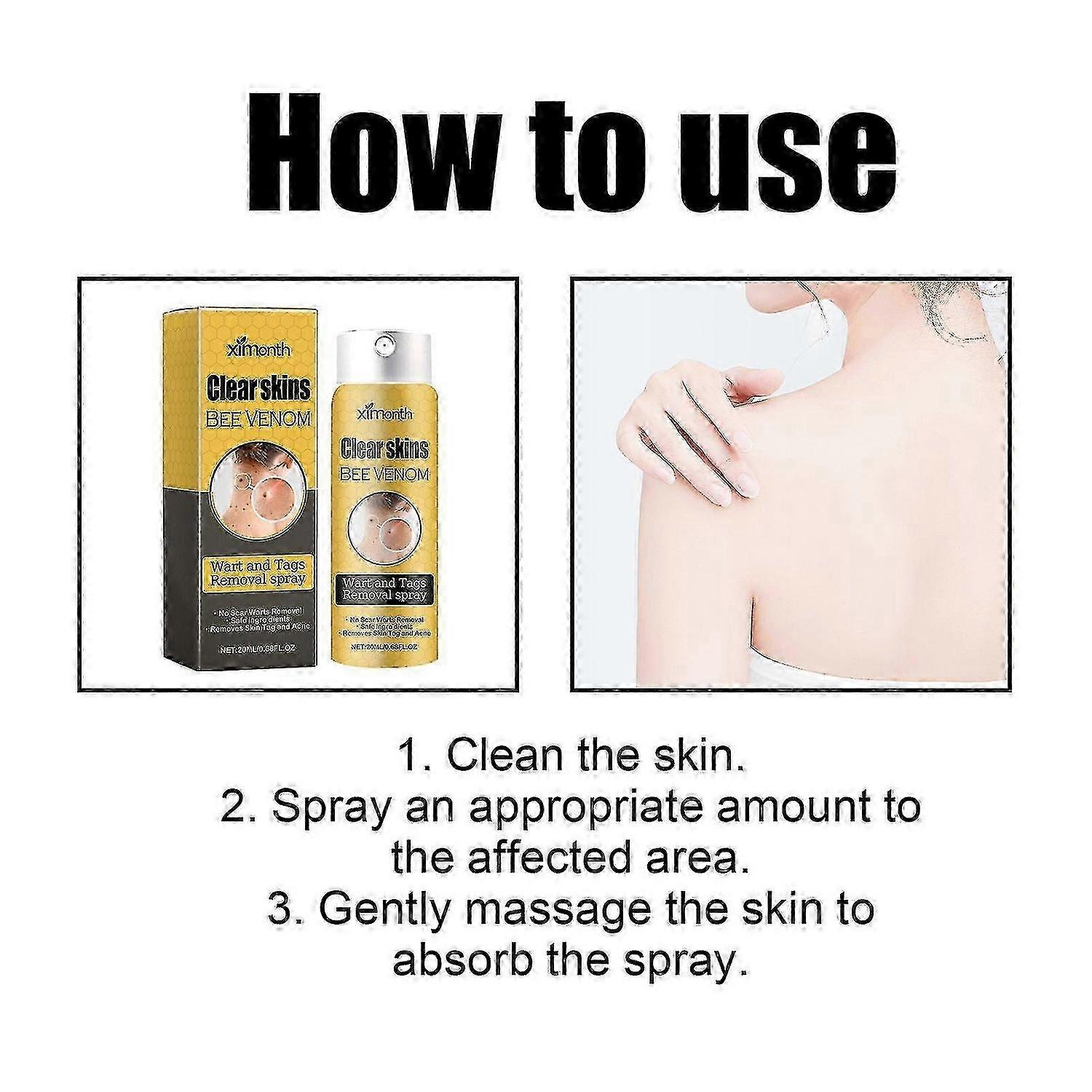 תרסיס להסרת יבלות ותגים, ניקוי ודהיית שומות גוף ספריי לתיקון עור חלק