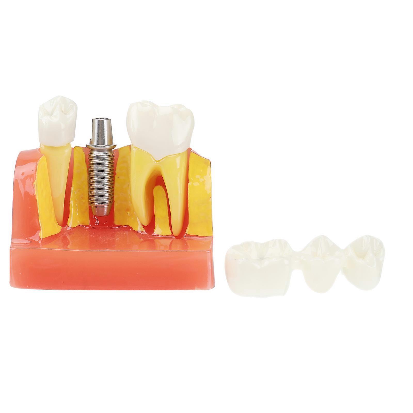 歯のインプラント教室の教師を教える教室のための歯の口モデル 3.50X2.75X3.50インチ 樹脂 1パック