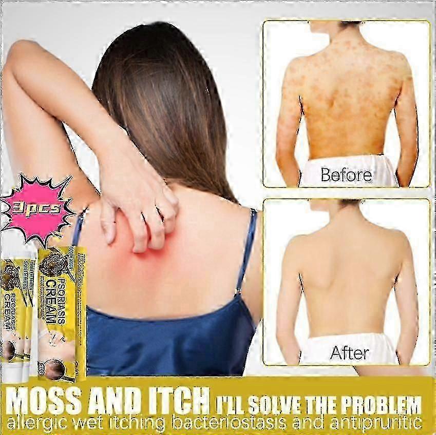 كريم إصلاح البشرة ، مرهم موضعي Versicolor ، كريم للبشرة مضاد للحكة ، لوشن Mois