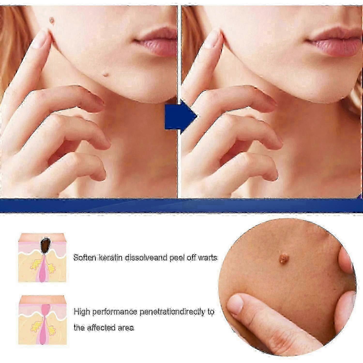 Genital Herpes Treatment Ointment