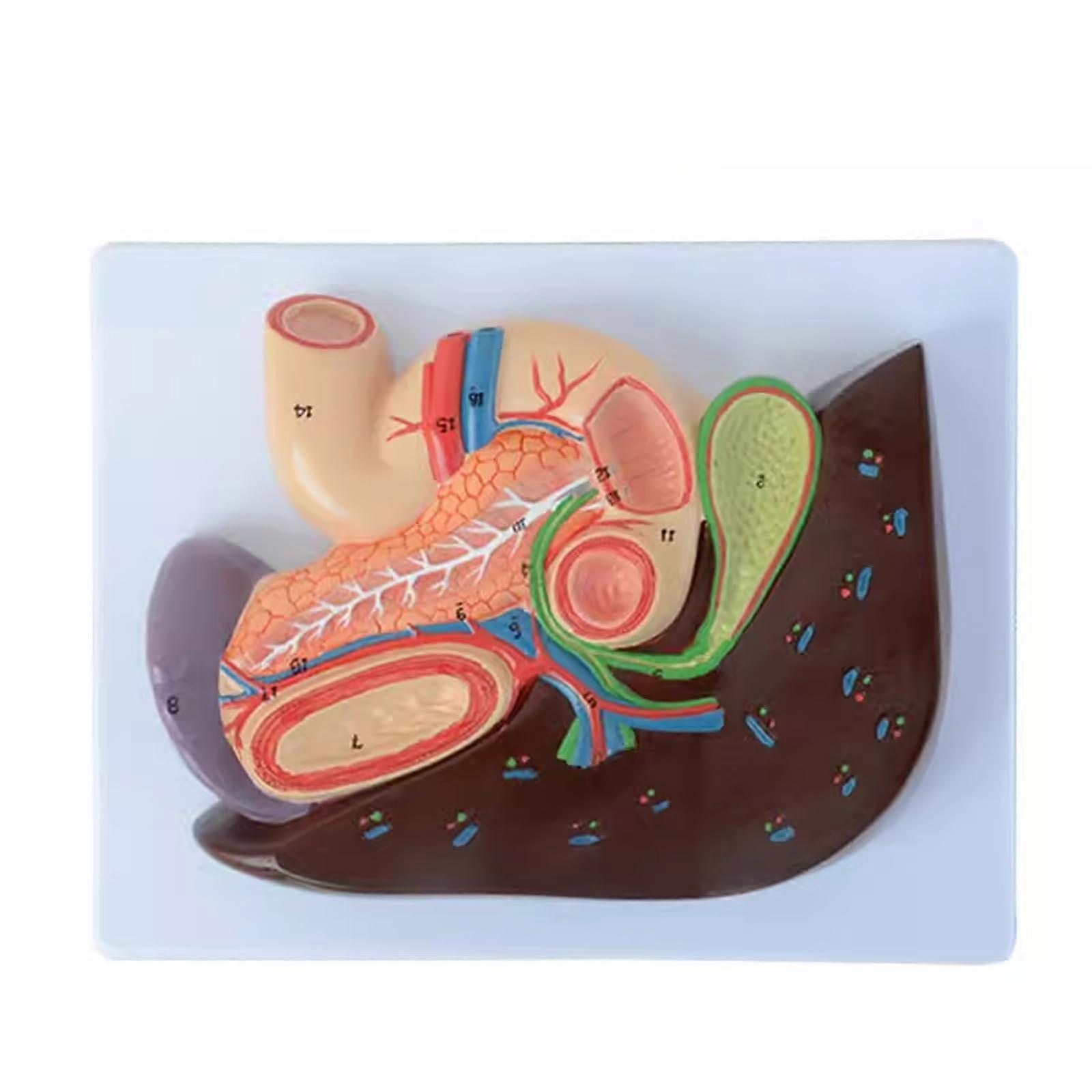 Pancreas Anatomical Model with Visible Pathological Features, 3D Pancreatic Duodenum Pathology Model for Medical Teaching