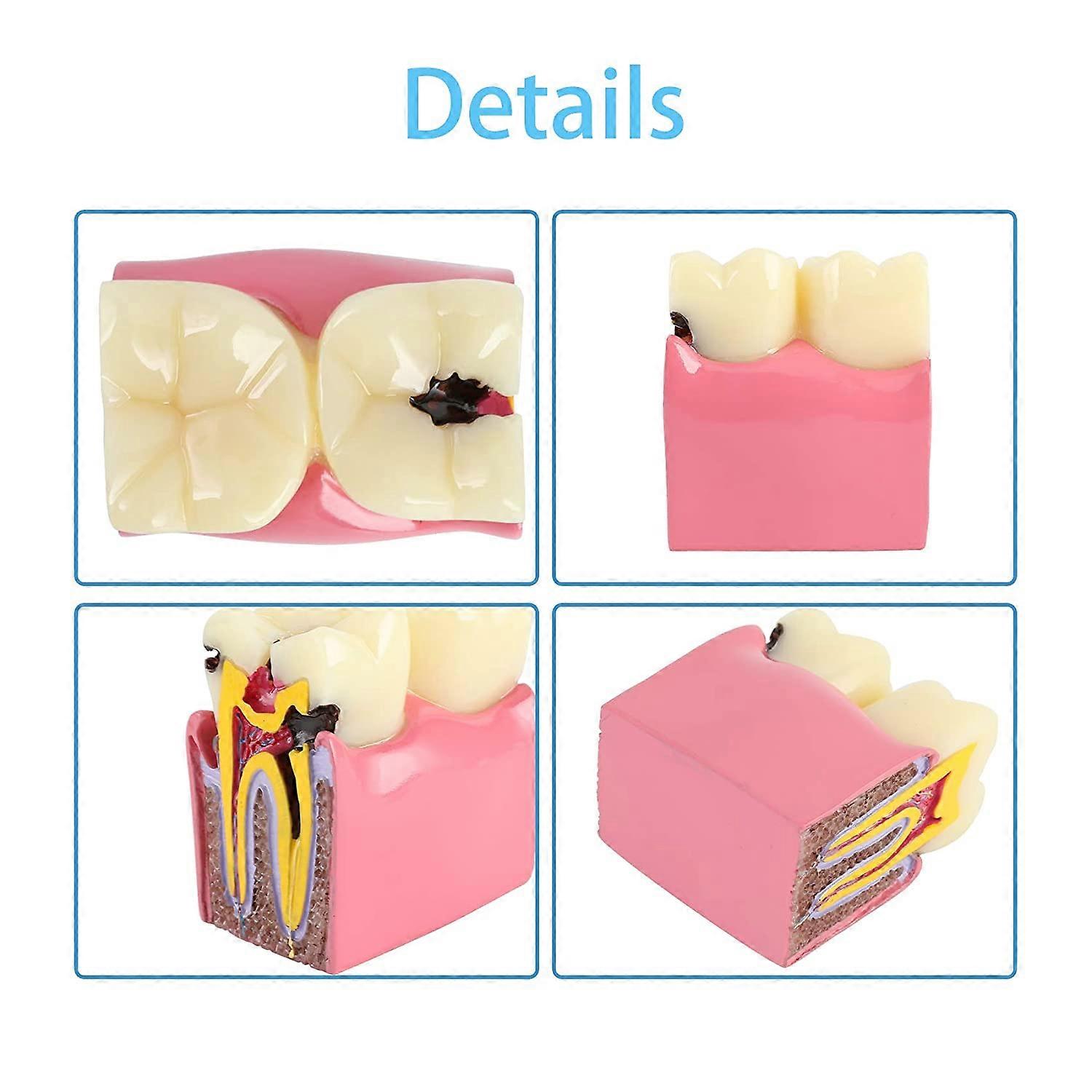 Dental Caries Tooth Model 6 Times Decay Teeth Comparative Study Model ...