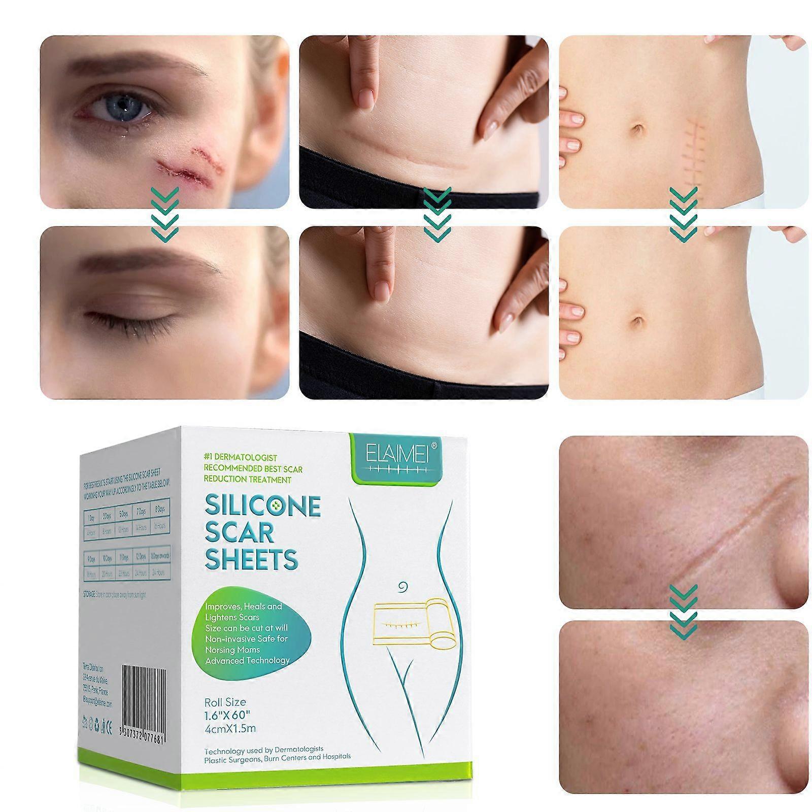 1-5pc scar roll patch small self-adhesive scar patch silicone gel invisible patch caesarean section stretch marks 1.5M d