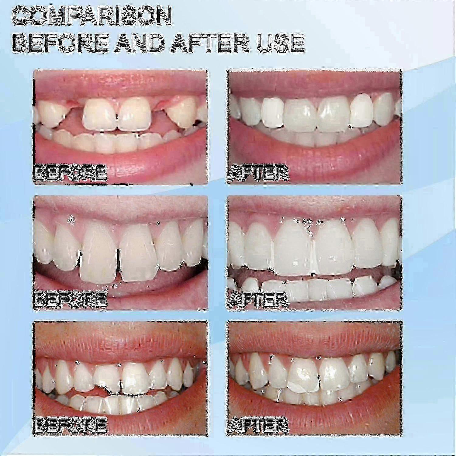 Reusable Moldable Teeth Filling Particles
