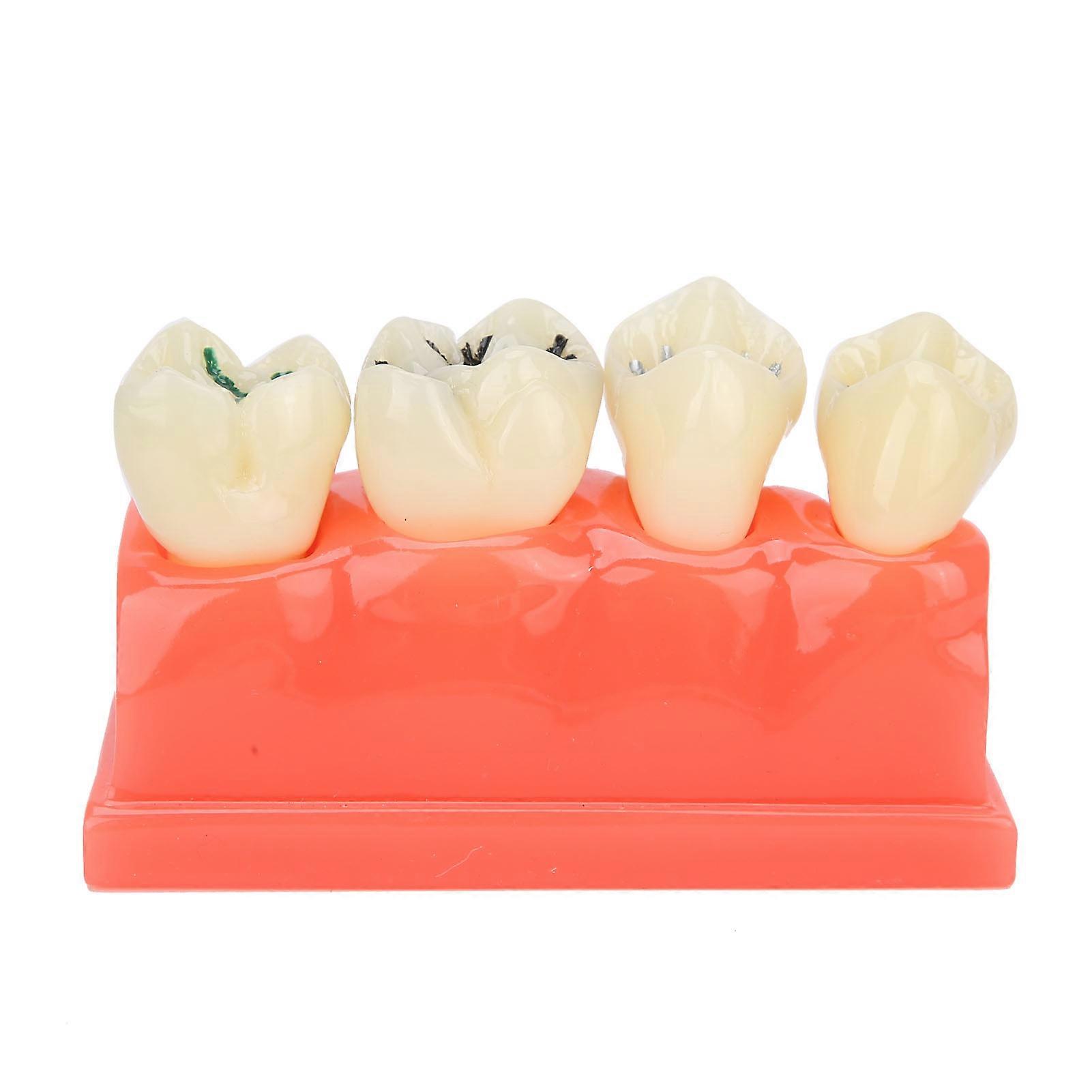 Caries Model Studying Demonstration Education Resin Dental Caries Model for School Dental Teaching