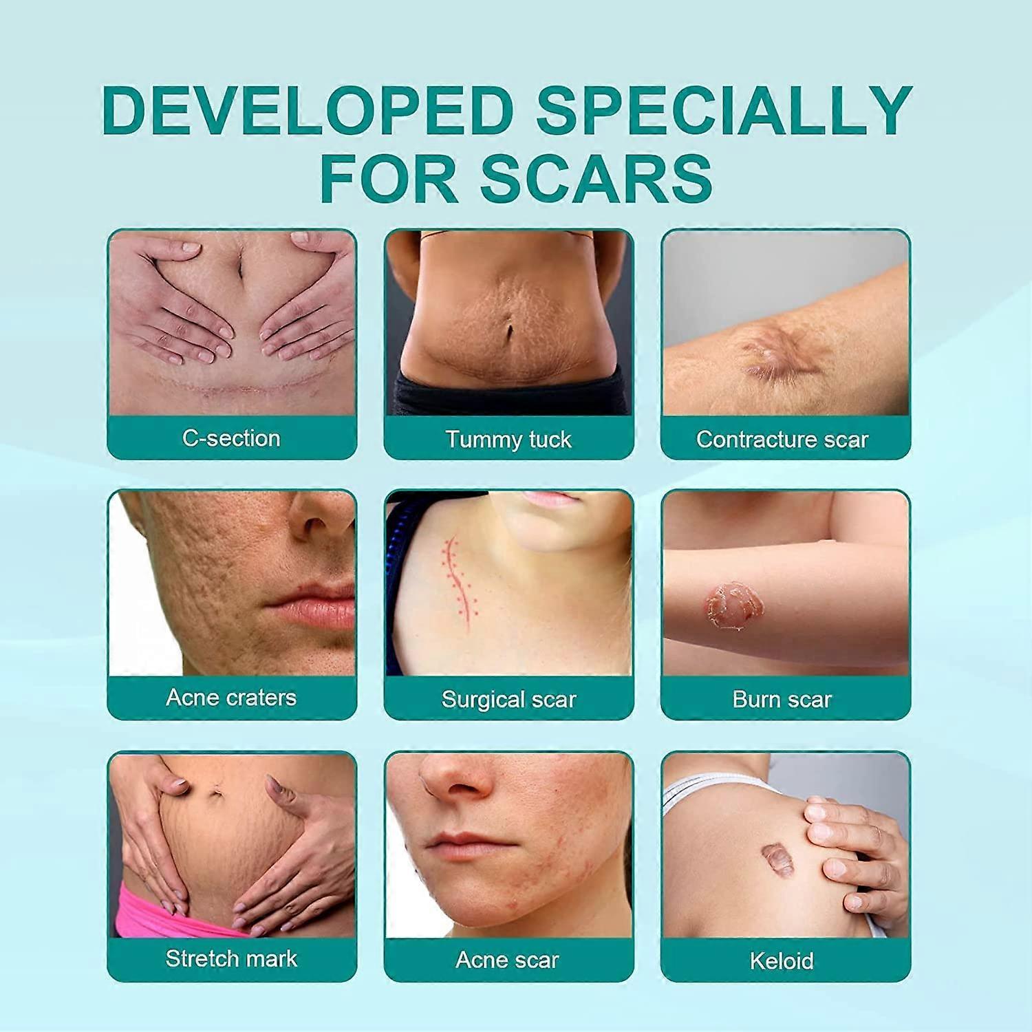 Scarremove Advanced Scar Spray for All Types of Scars - Especially Acne Scars Scar Remove Advanced Scar Spray (2 Pieces)