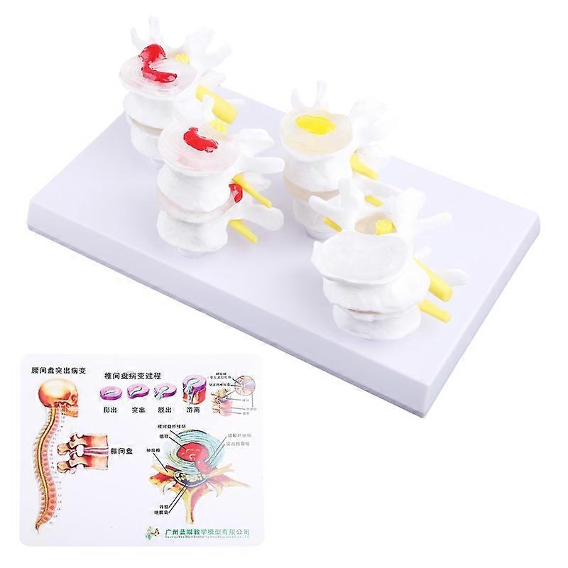 1 Set Human Lumbar Lesion Spine Statue Display Model Medical Teaching Learning f