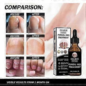 Nagelreparatur Flüssige Verdickung Und Helle Nägel, Nail Fu