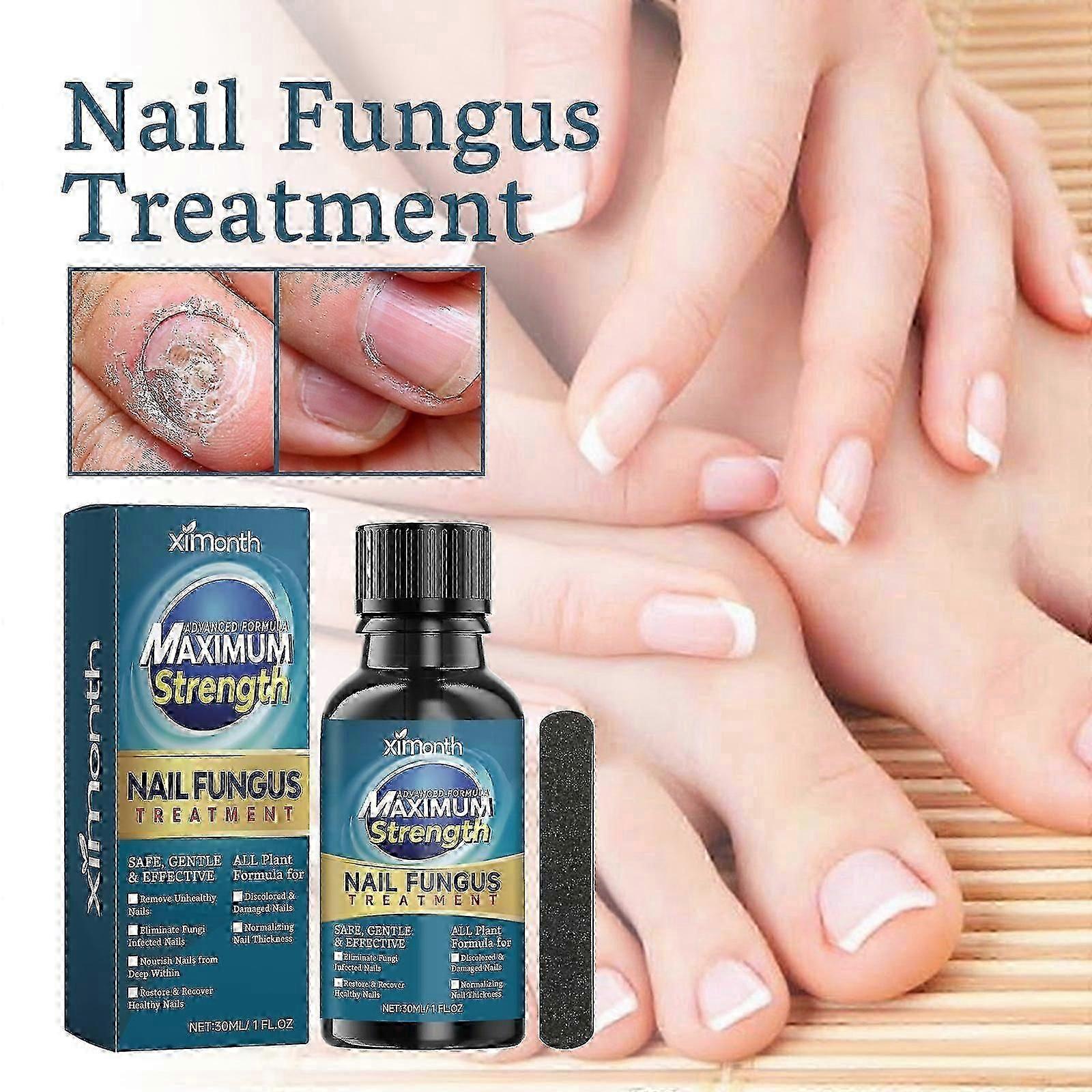 Nail sopp behandling for tånegler, tånegl sopp behandling, ekstra styrke spiker sopp behandling for fingre og tånegler, sopp Nail Killer