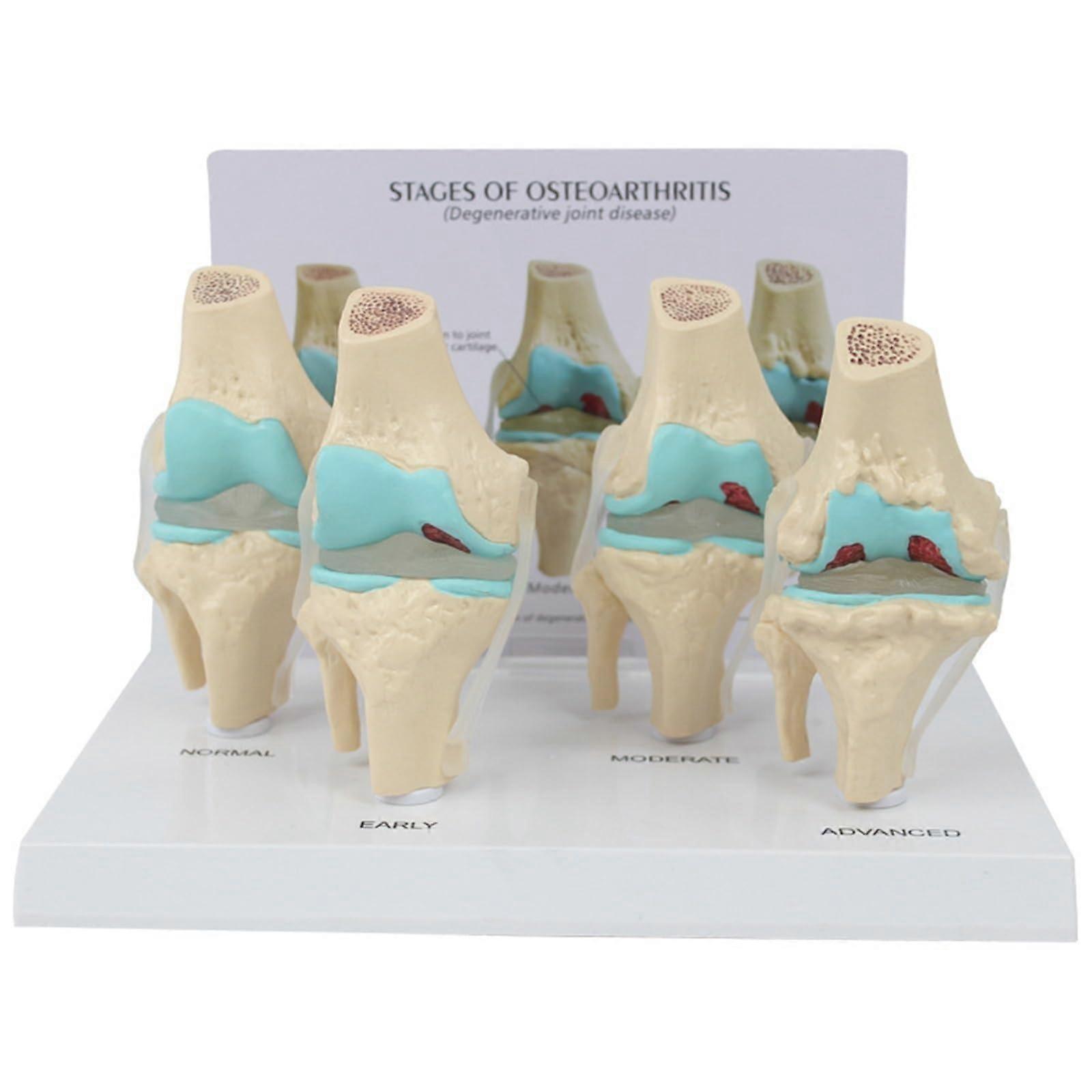 4Stage Knee Joint Anatomical Model with Clear Stage Comparison for Osteoarthritis Study and Teaching