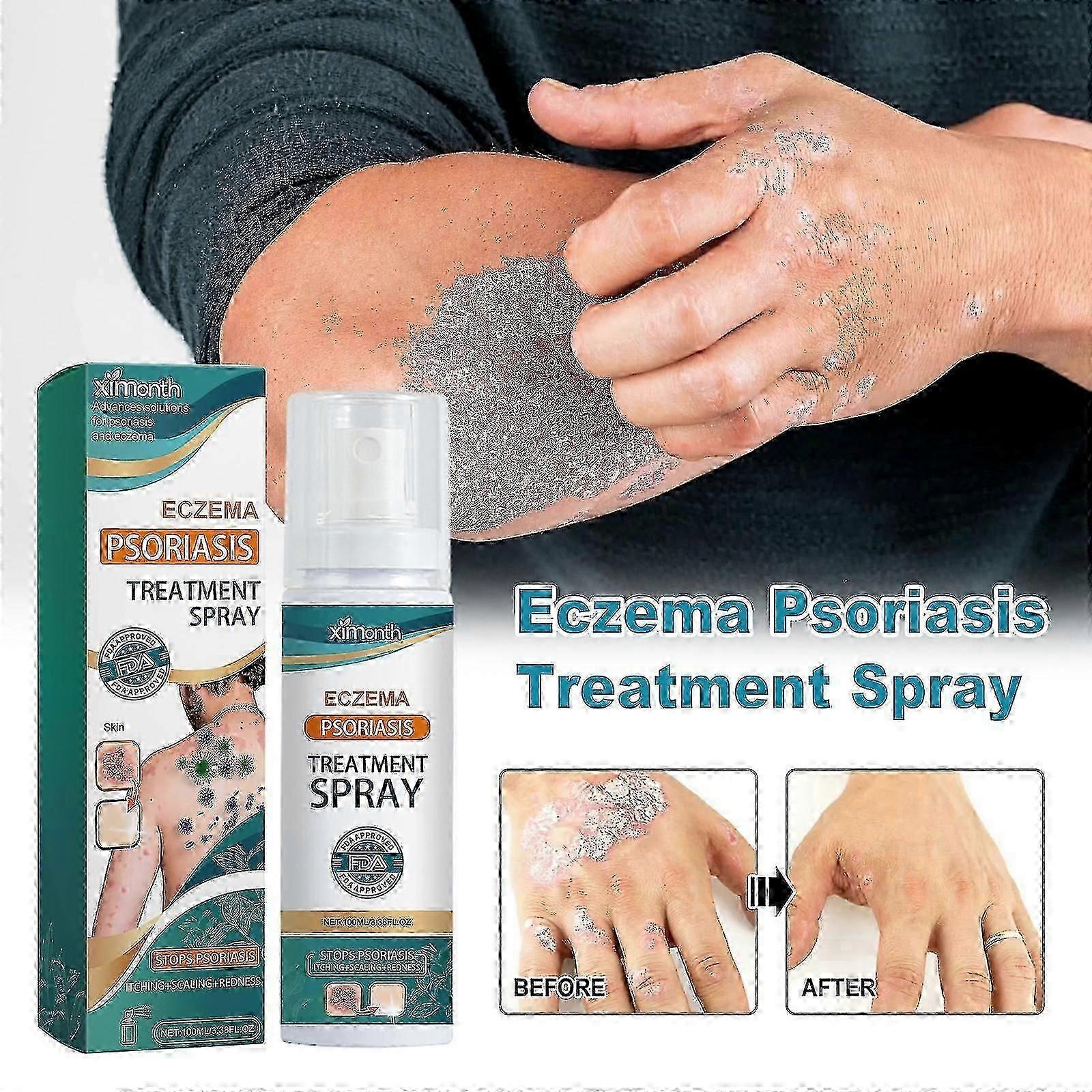 بخاخ علاج الصدفية الأكزيما ، رذاذ تخفيف الصدفية العشبية رذاذ تخفيف الأكزيما رذاذ علاج الصدفية البهاق رذاذ إصلاح الجلد