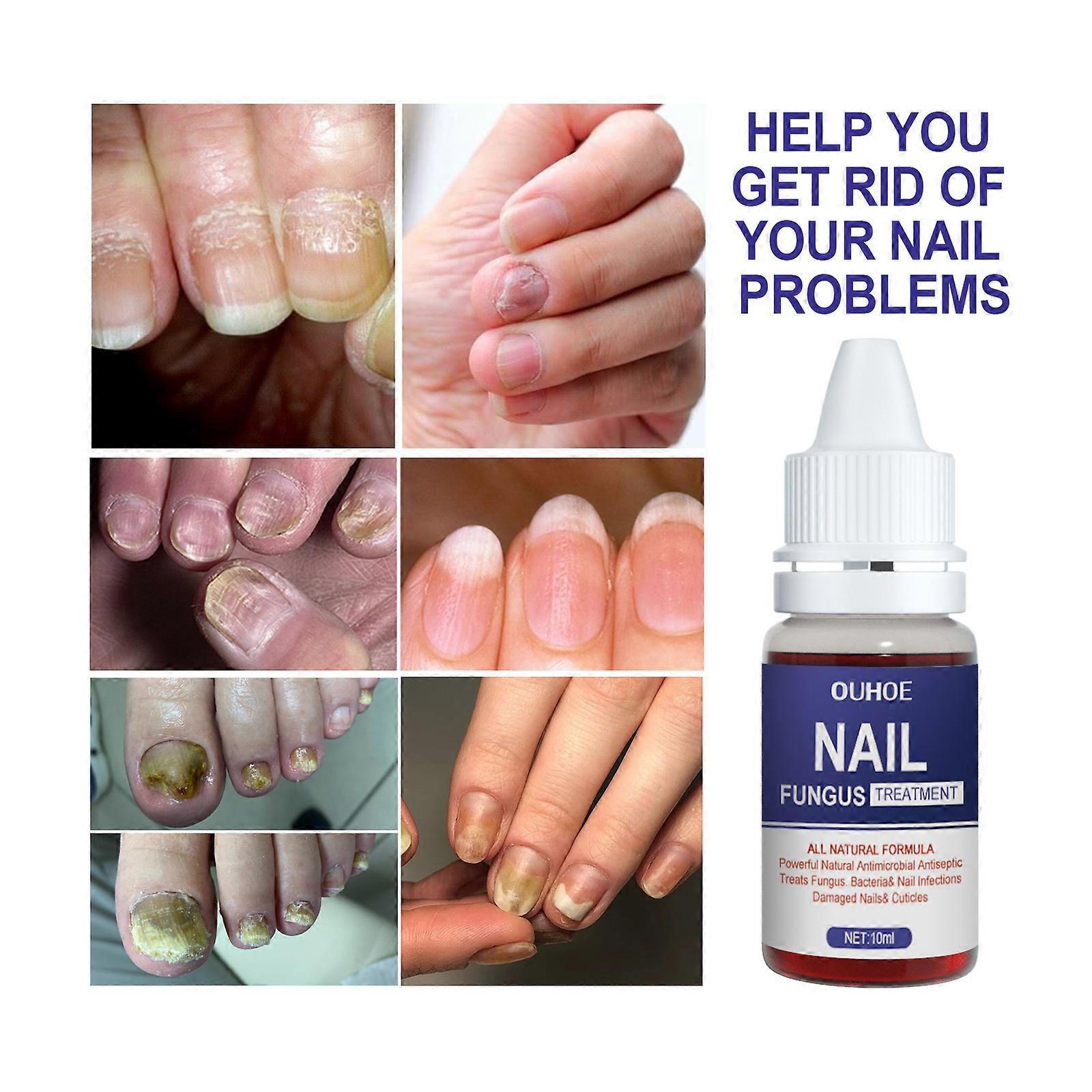 Toenail Fungus Treatment, Nail Fungus Treatment Extra Strength for Athletes Foot, Thick, Broken, Discolored & Damaged Nail
