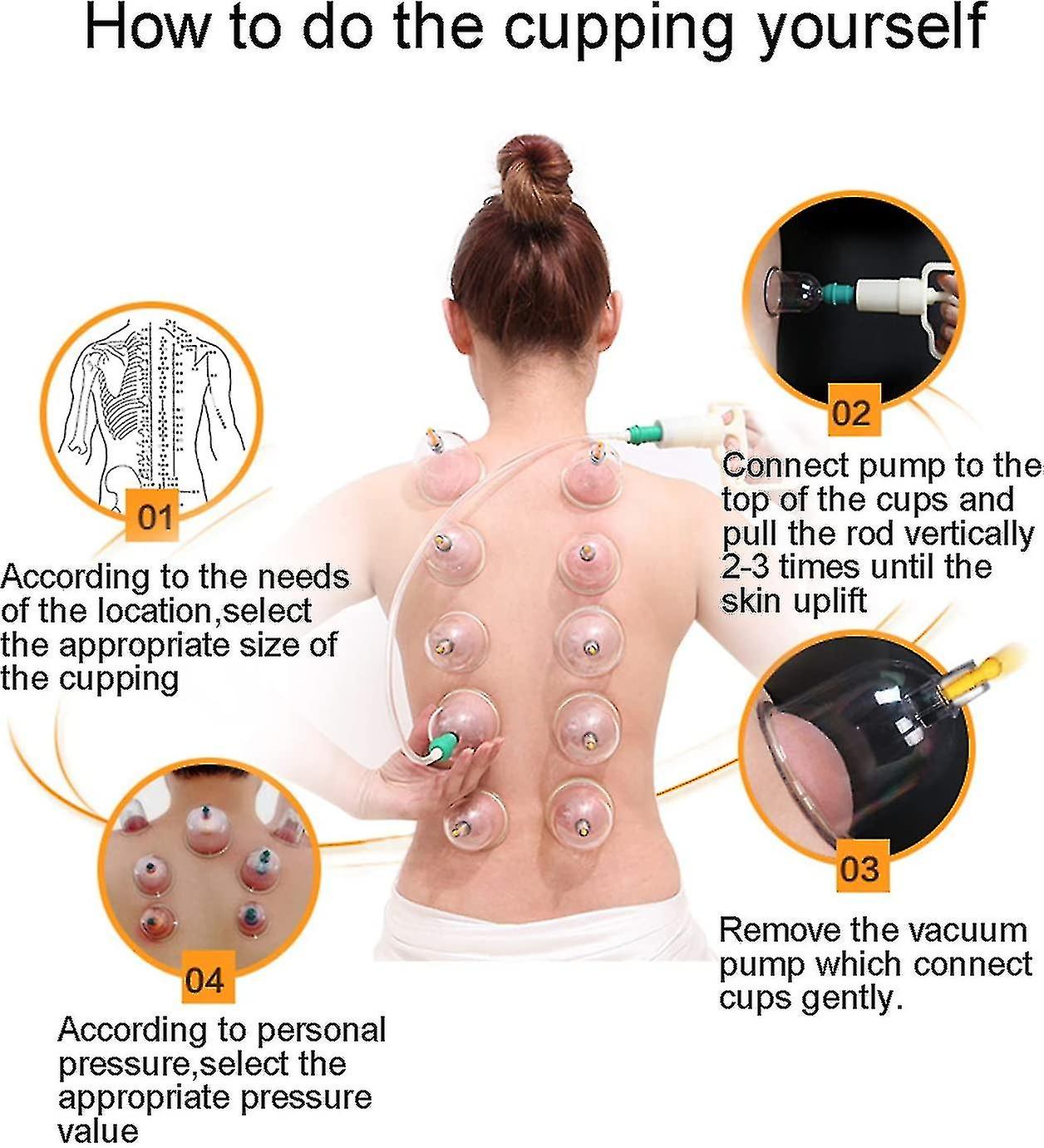 Cupping Beneficios De La Ventosaterapia Ventosas Espalda Moretones