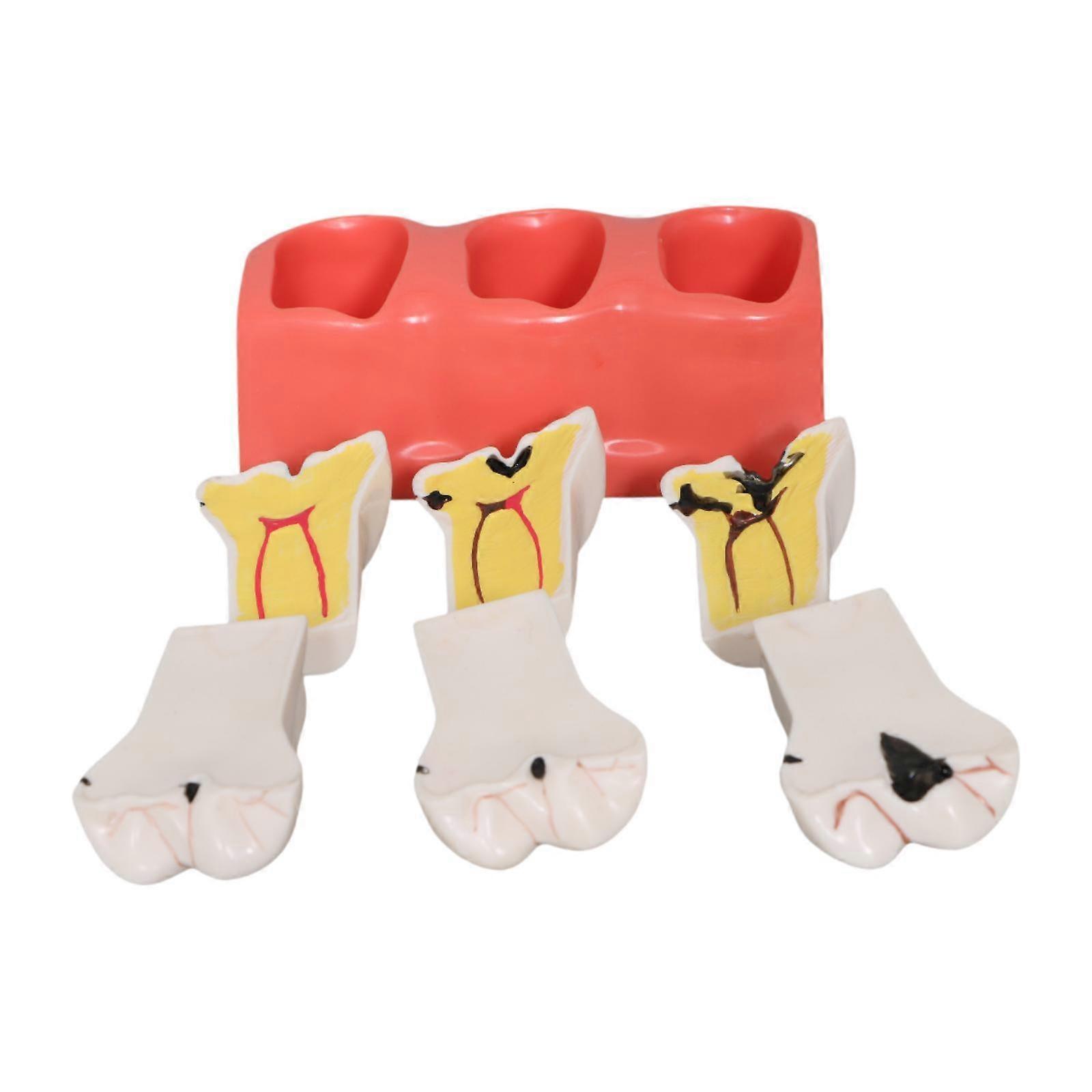 Decay Teeth Model Education Teaching Aid for Students Classroom Patients