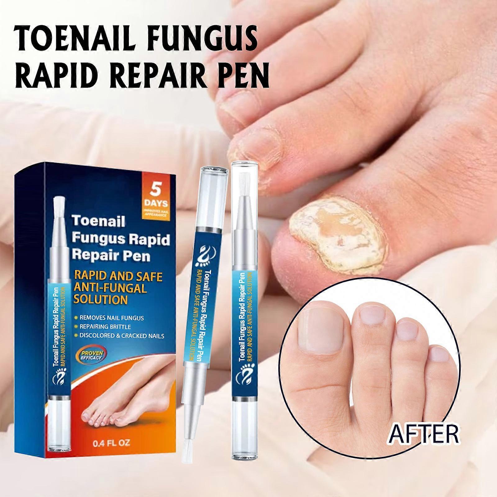 Tånagelsvamp Behandling, Nagelsvamp Behandling Penna, Nagelreparation Förnyelse Svamp Nagel Lösning Penna Förnya missfärgade skadade naglar