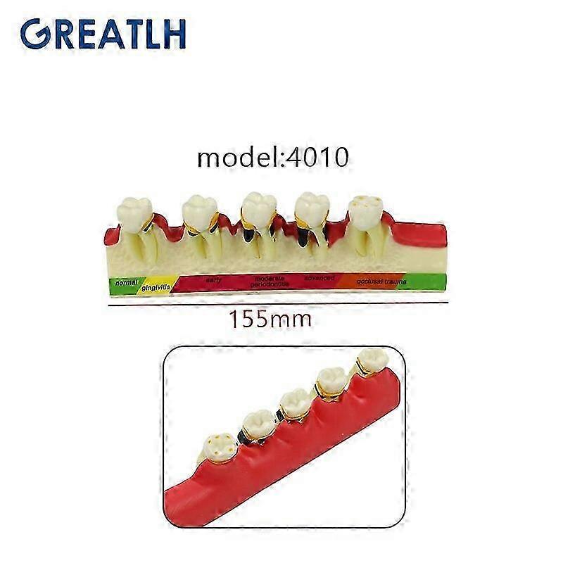 Material dentar standard, model dentar, ecran de evaluare a cariilor