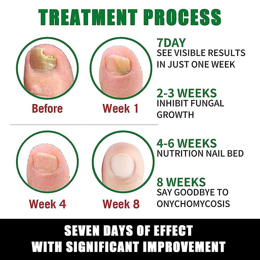 Patch Antifongique Pour Ongles - Traitement Contre Les Mycoses - Soin Réparateur Pieds - Neuf