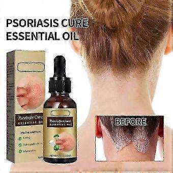 Tratamento para caspa e psoríase no couro cabeludo em 2025, estimulante folicular anti-coceira - jinm
