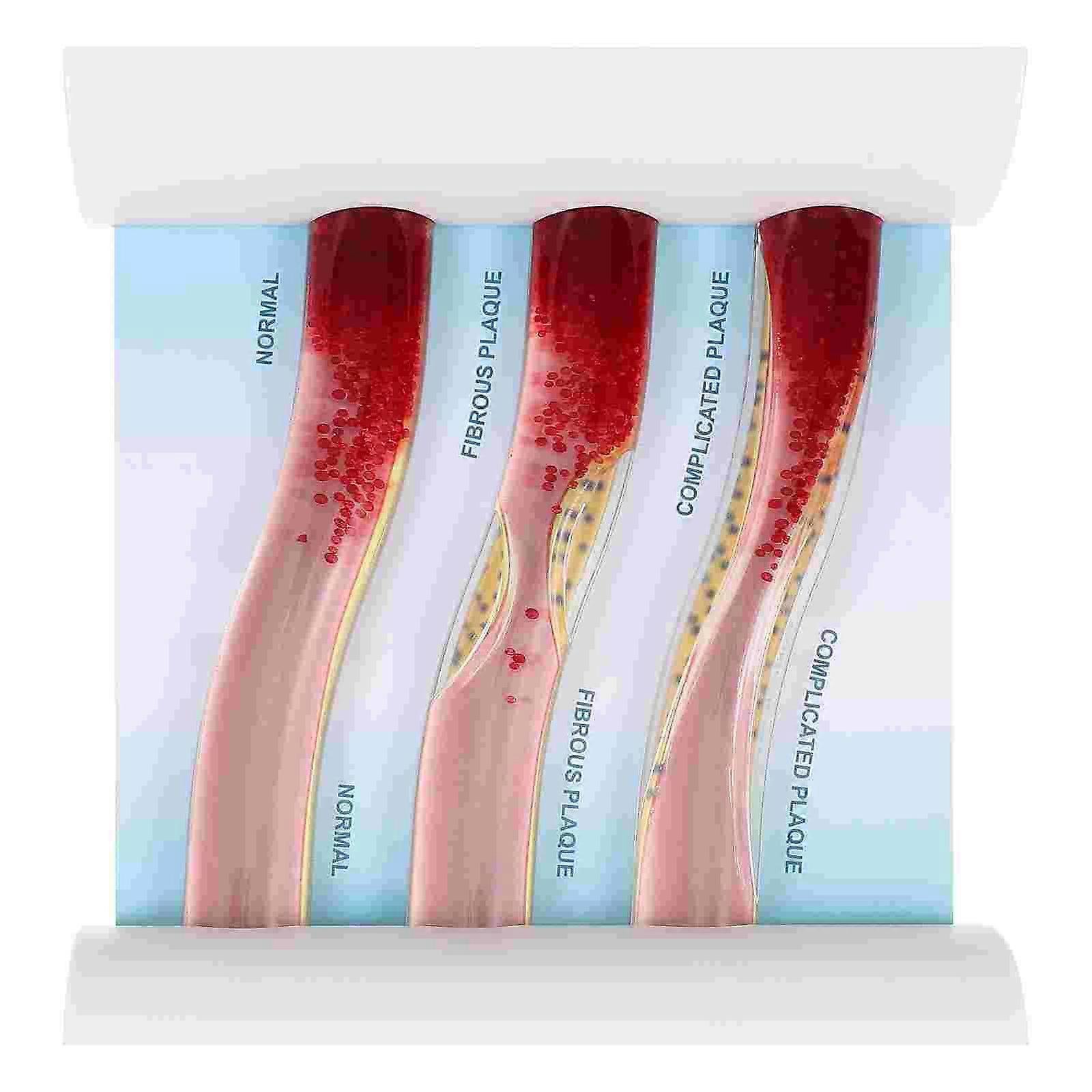Dynamic Blood Vessel Model Cardiovascular Blockage Contrast Model Thrombosis Model for Teaching Explanation