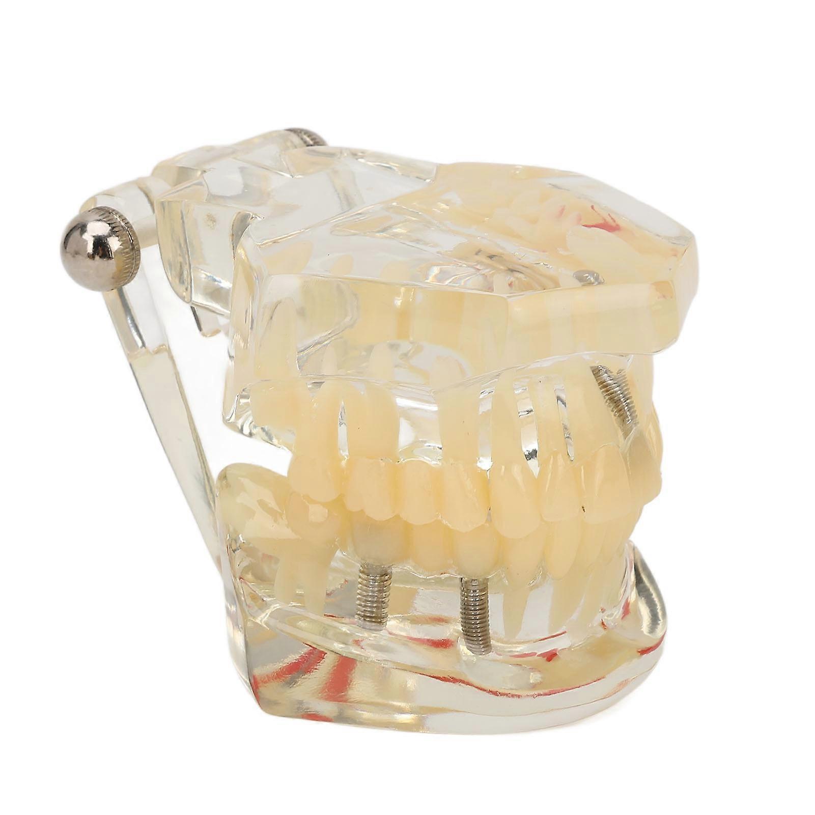 Dental Implant Model Transparent Clear Display Pathological Disease Teeth Model for Teaching Aid