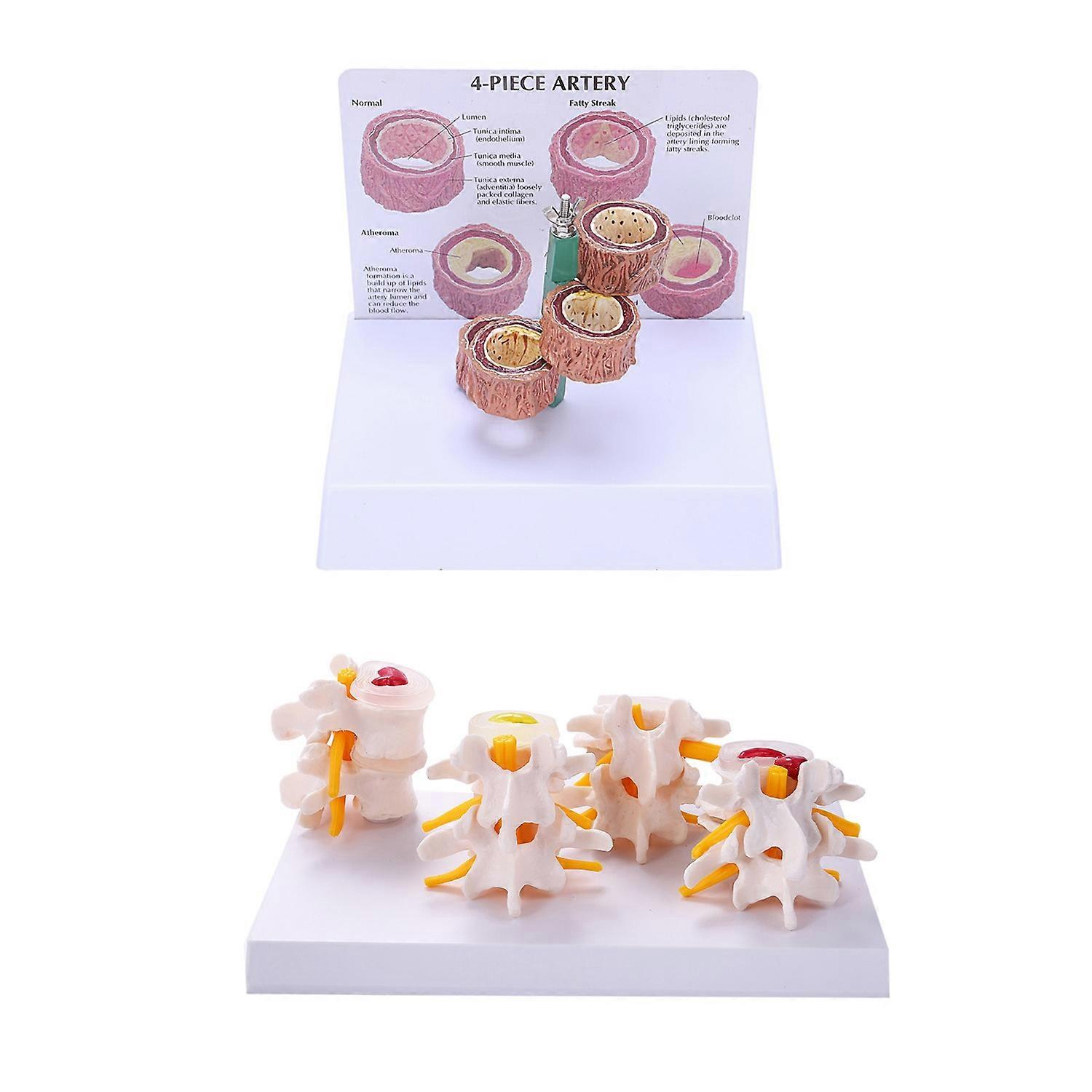 1 Adet Vasküler Patoloji Modeli ve 1 Adet İnsan Anatomisi İskelet Omurga 4- Model