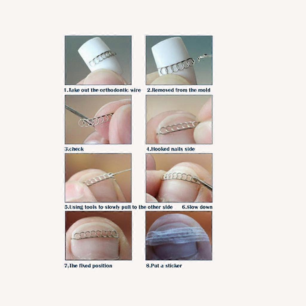 Outils de soins des pieds Autocollants de fil de correction d’ongles d’orteil pour ongles incarnés