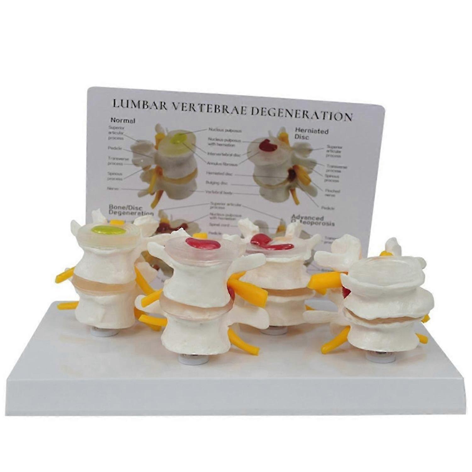 Four Stage Vertebrae Model, Human Anatomy and Physiology Educational