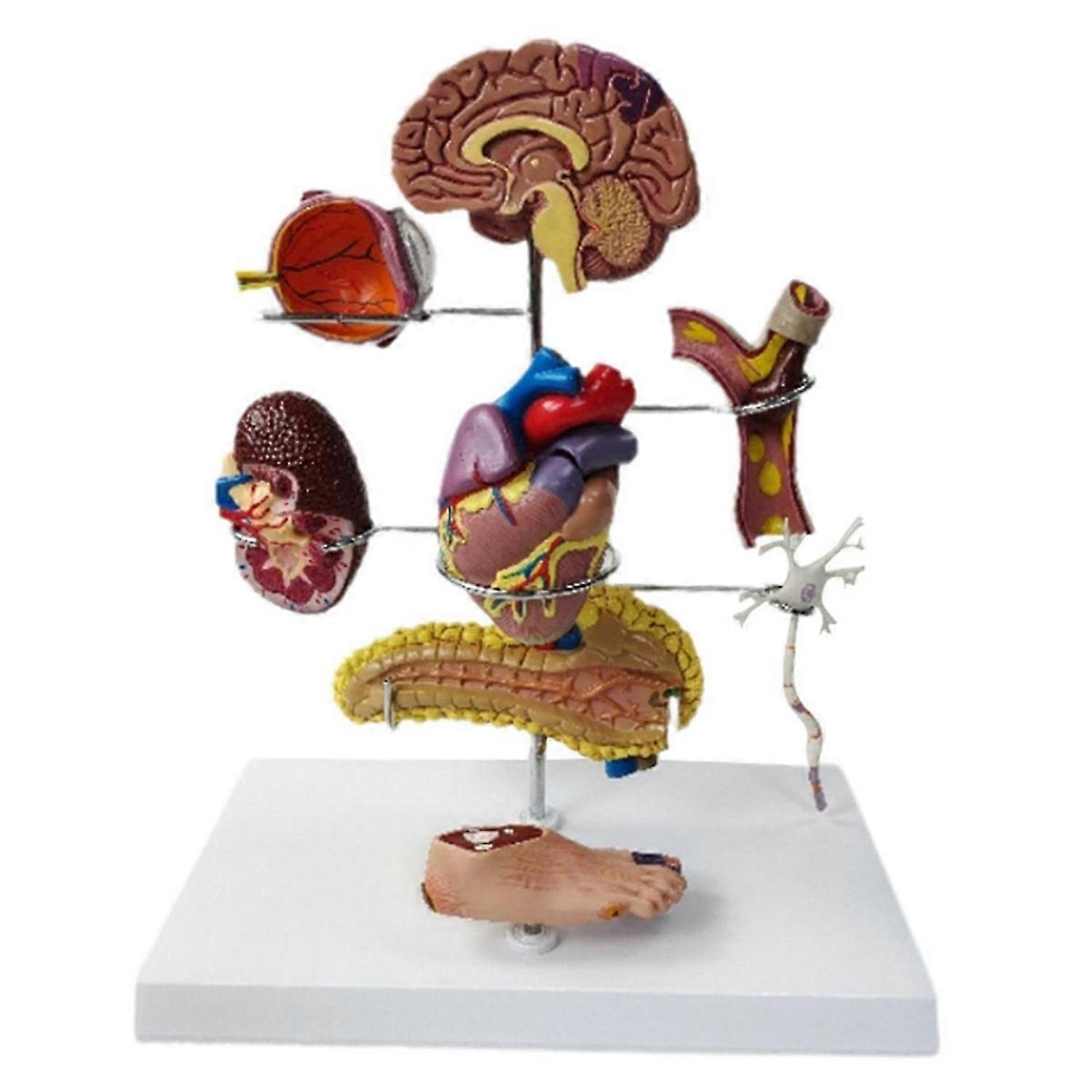 Type Ii Diabetes Model Set, For Human Anatomy And Physiology