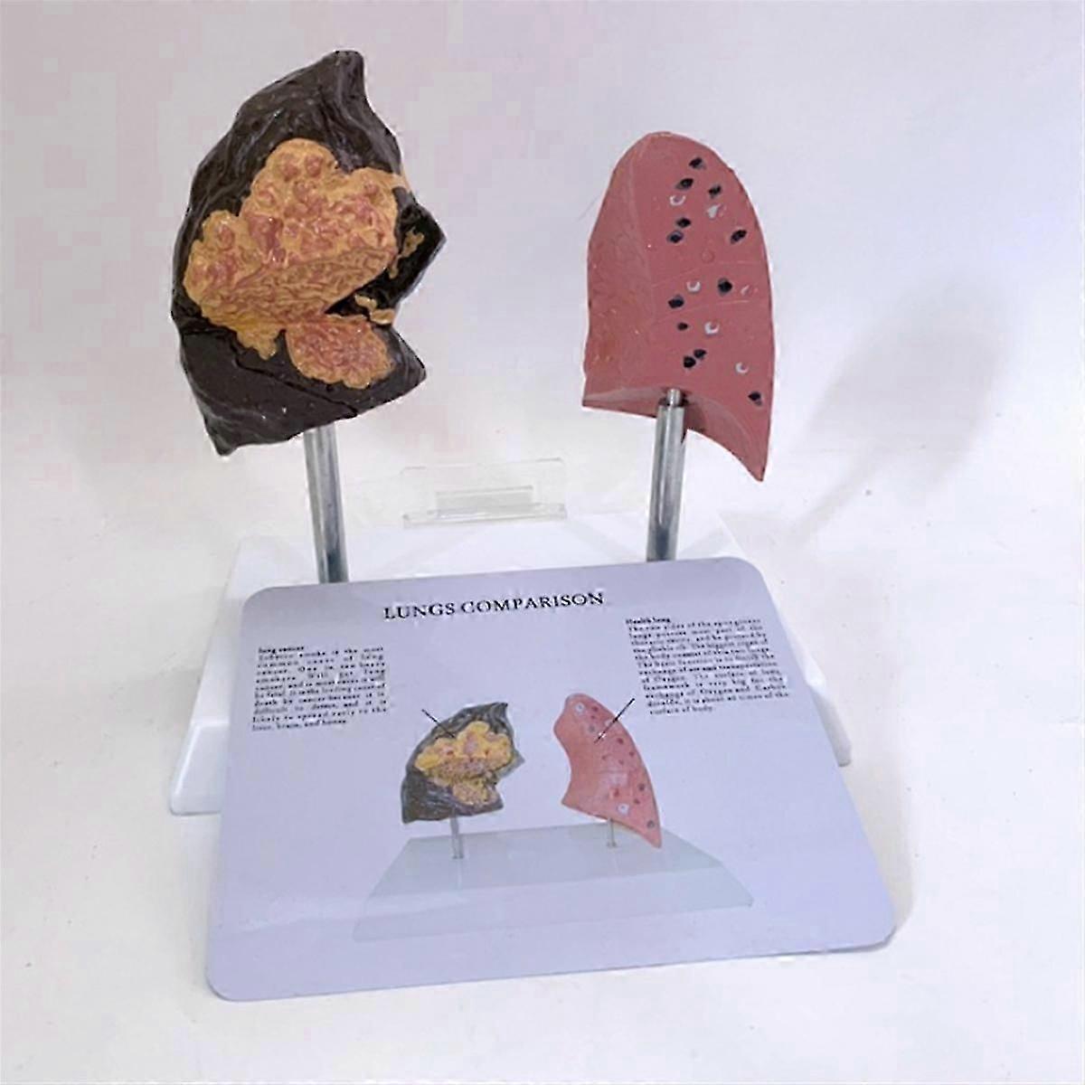Smoker's Lung Model Healthy Lung Model Lung Anatomy Model With Pathological Respiratory System Dise