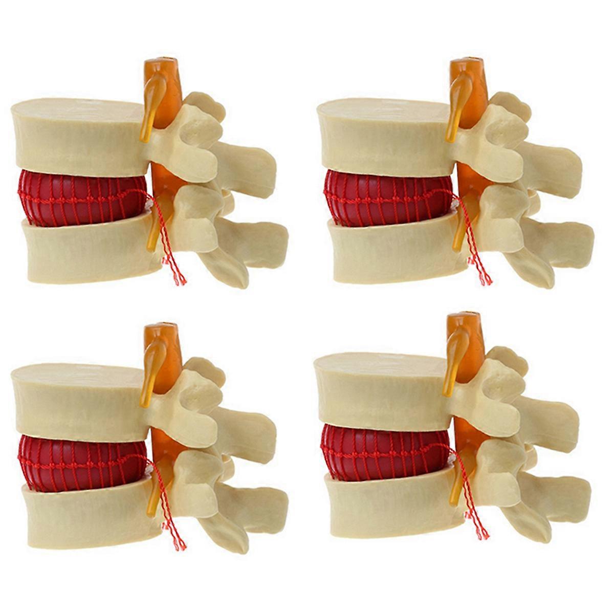 Lumbar Vertebrae Model Lumbar Disc Herniation Anatomy Teaching Tool