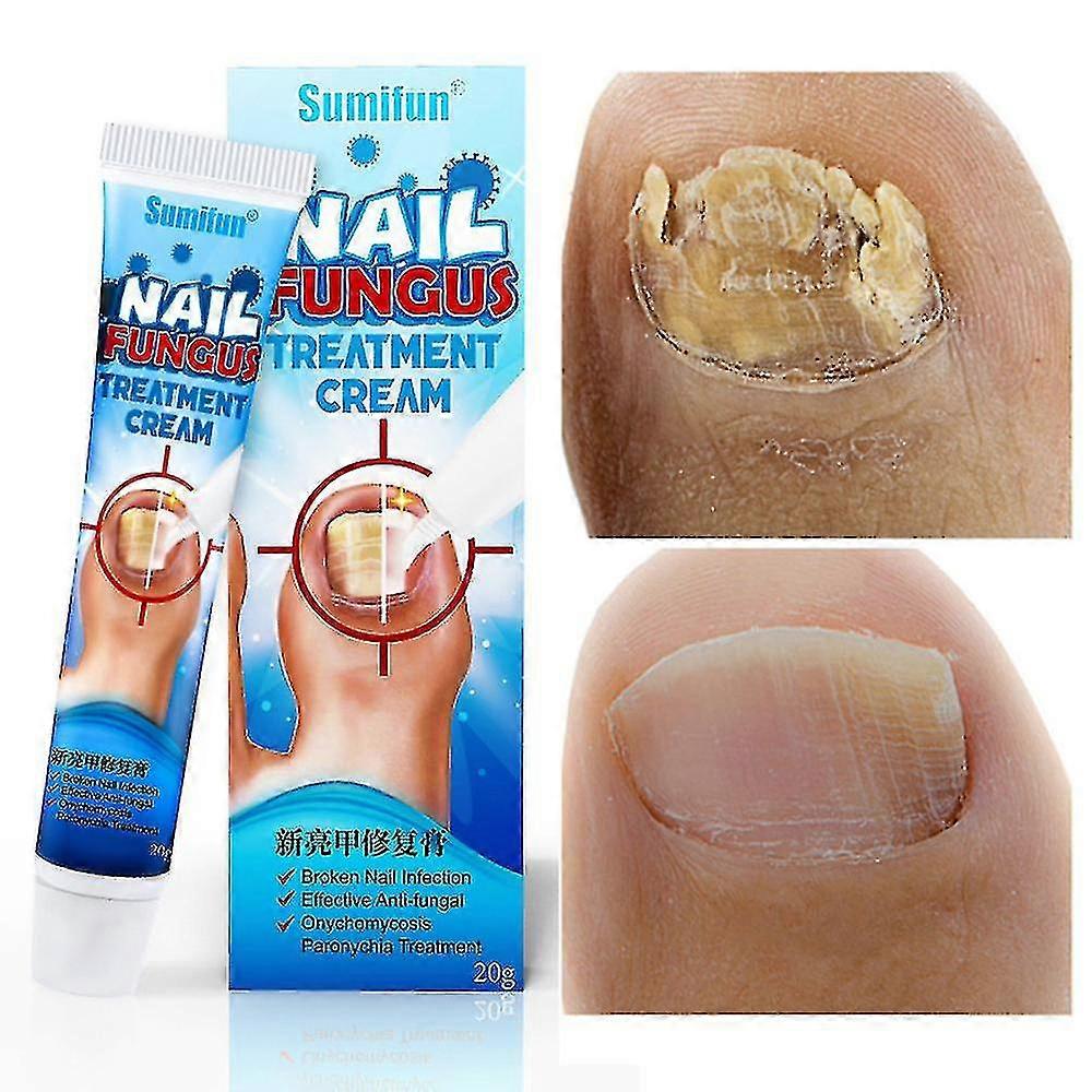 3pcs Highly Kills Toe Fungus Tw
